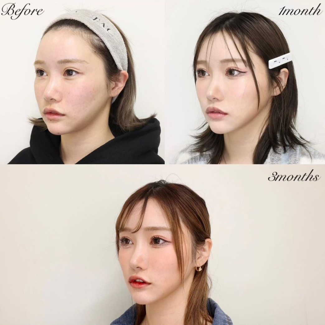 TAC式 ツヤ肌コラーゲンリフト®/ジョールファット除去/エラボトックス注射の症例写真 施術前後