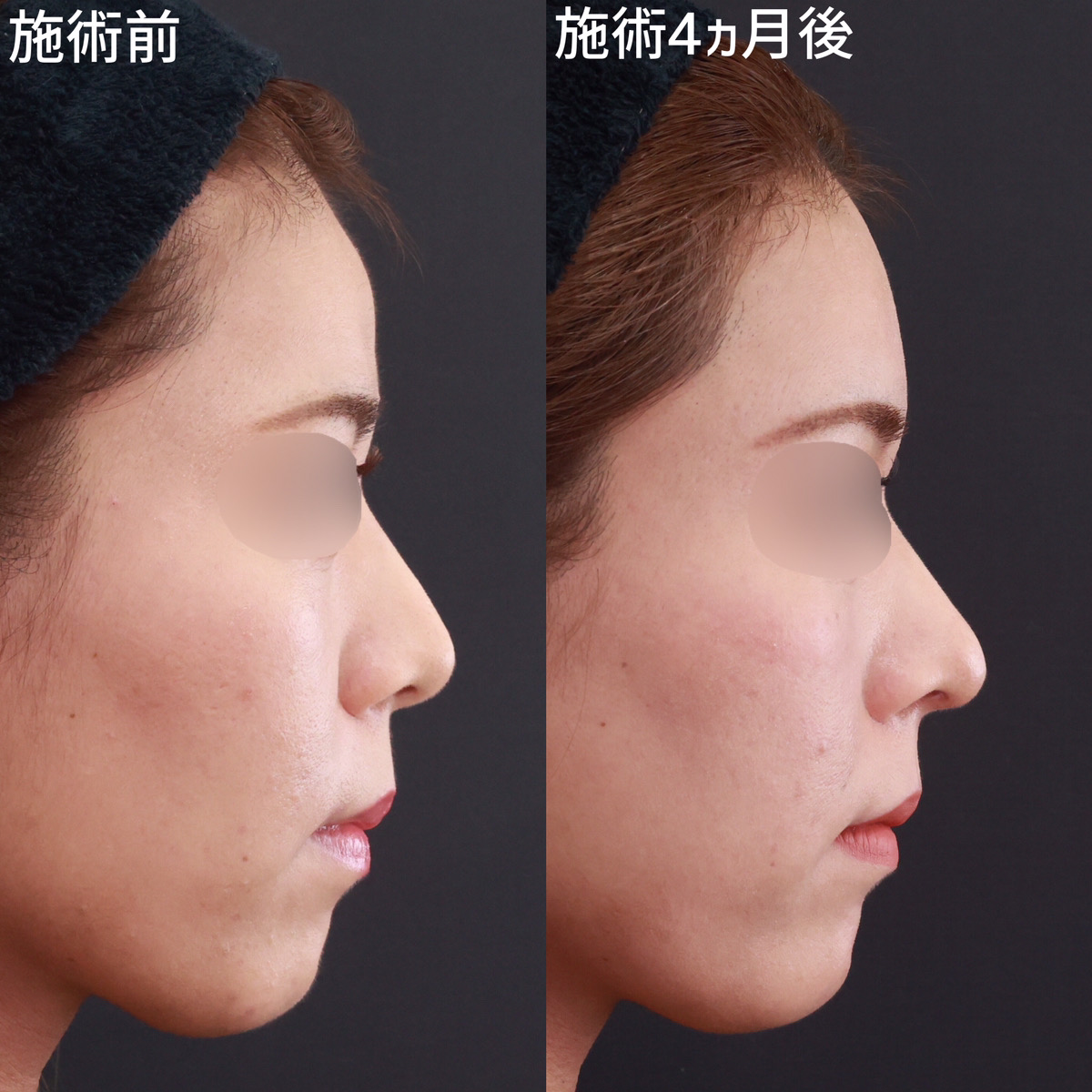 【鼻複合施術×コンデンスリッチフェイス】より洗練された横顔へ