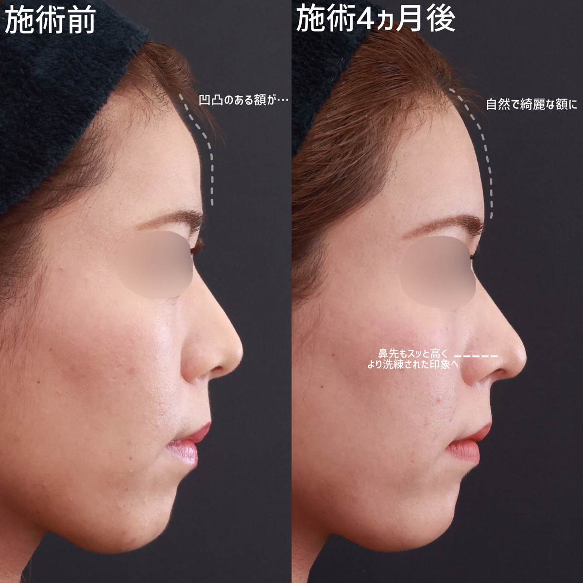 おでこの脂肪注入（オルチャンデコ形成）/鼻中隔延長術/鼻先軟骨移植の症例写真 施術前後 