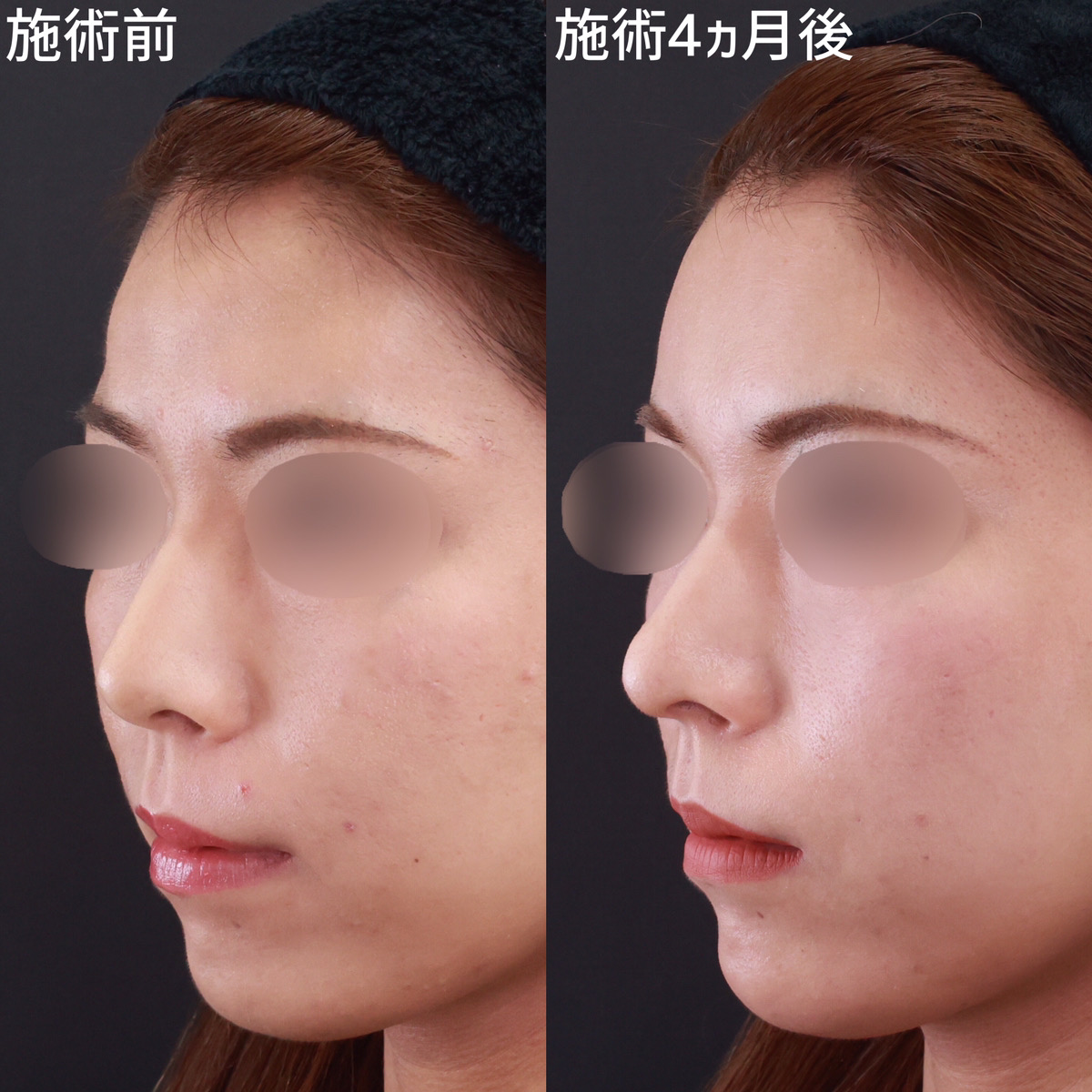 おでこの脂肪注入（オルチャンデコ形成）/鼻中隔延長術/鼻先軟骨移植の症例写真 施術前後 