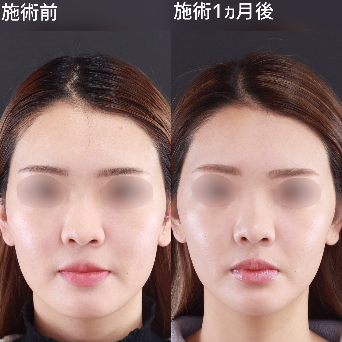 【小顔施術】四角い輪郭から卵型の輪郭へ