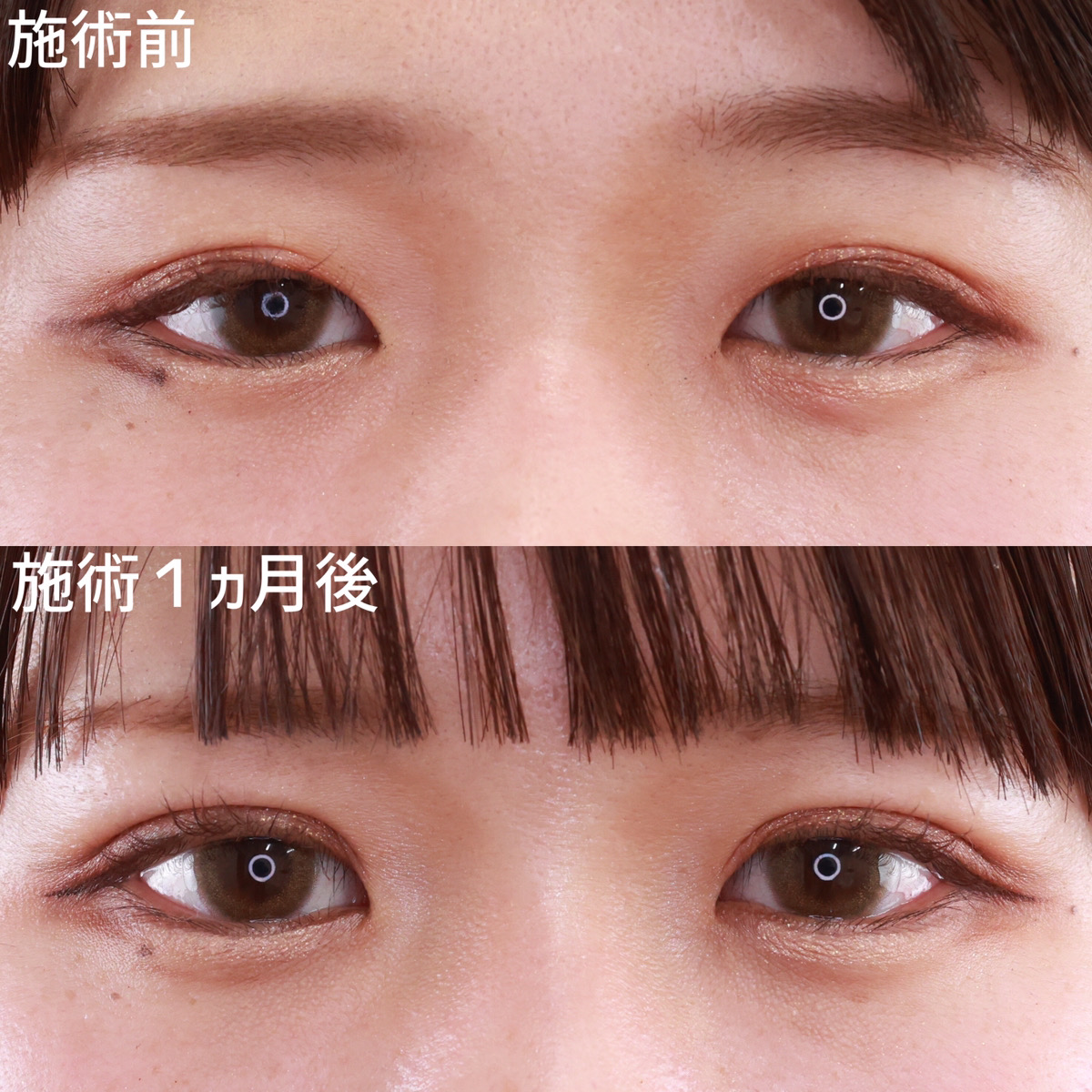 【二重埋没法】安定しない二重もたった15分で解決！