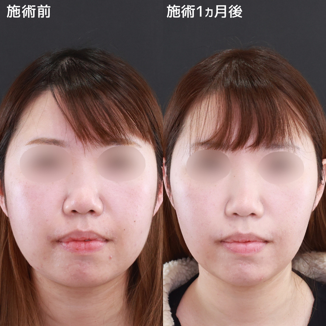 【小顔施術】一回り小さいお顔で、自信の持てる輪郭に！