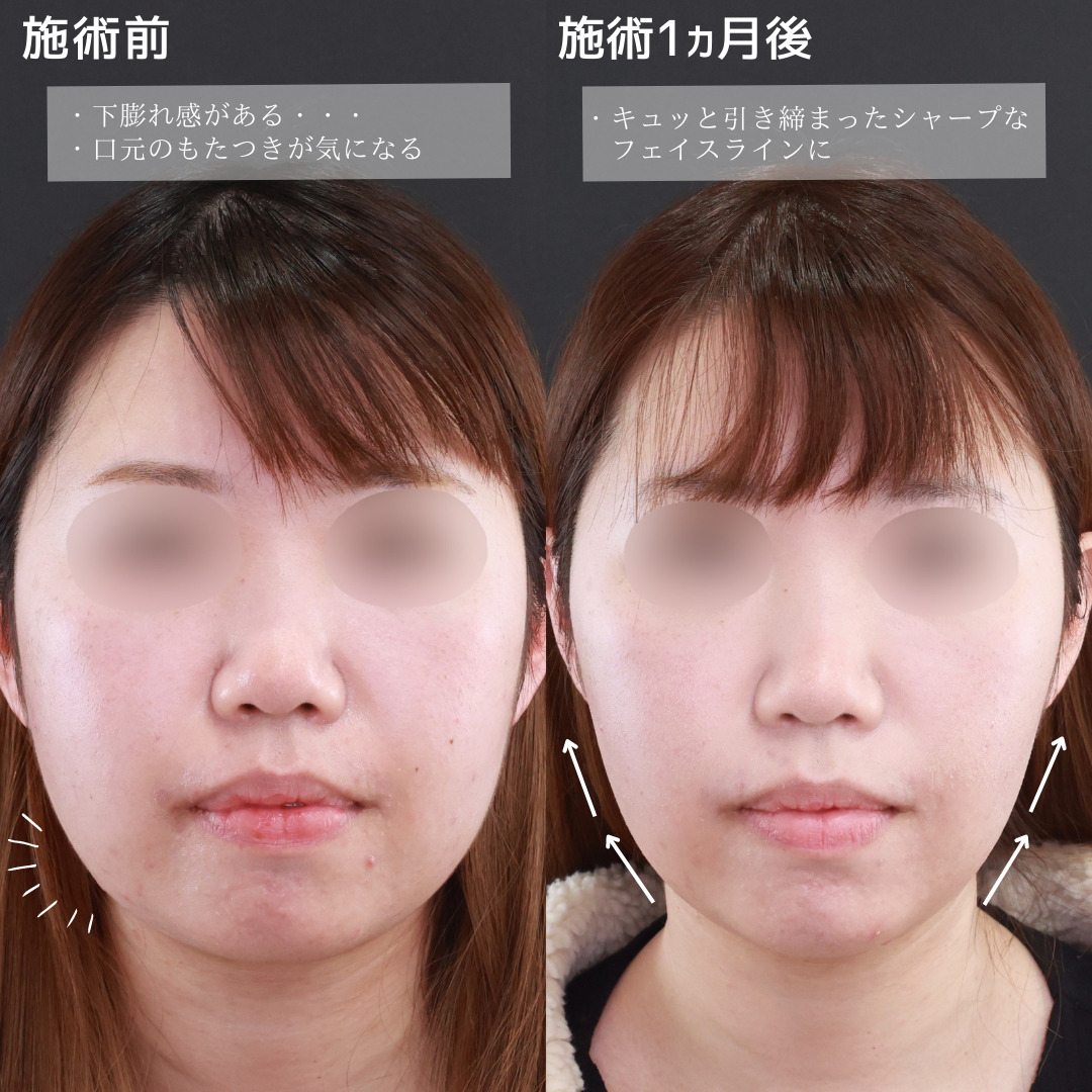 ジョールファット除去/バッカルファット除去/TAC式 ツヤ肌コラーゲンリフト®の症例写真 施術前後 