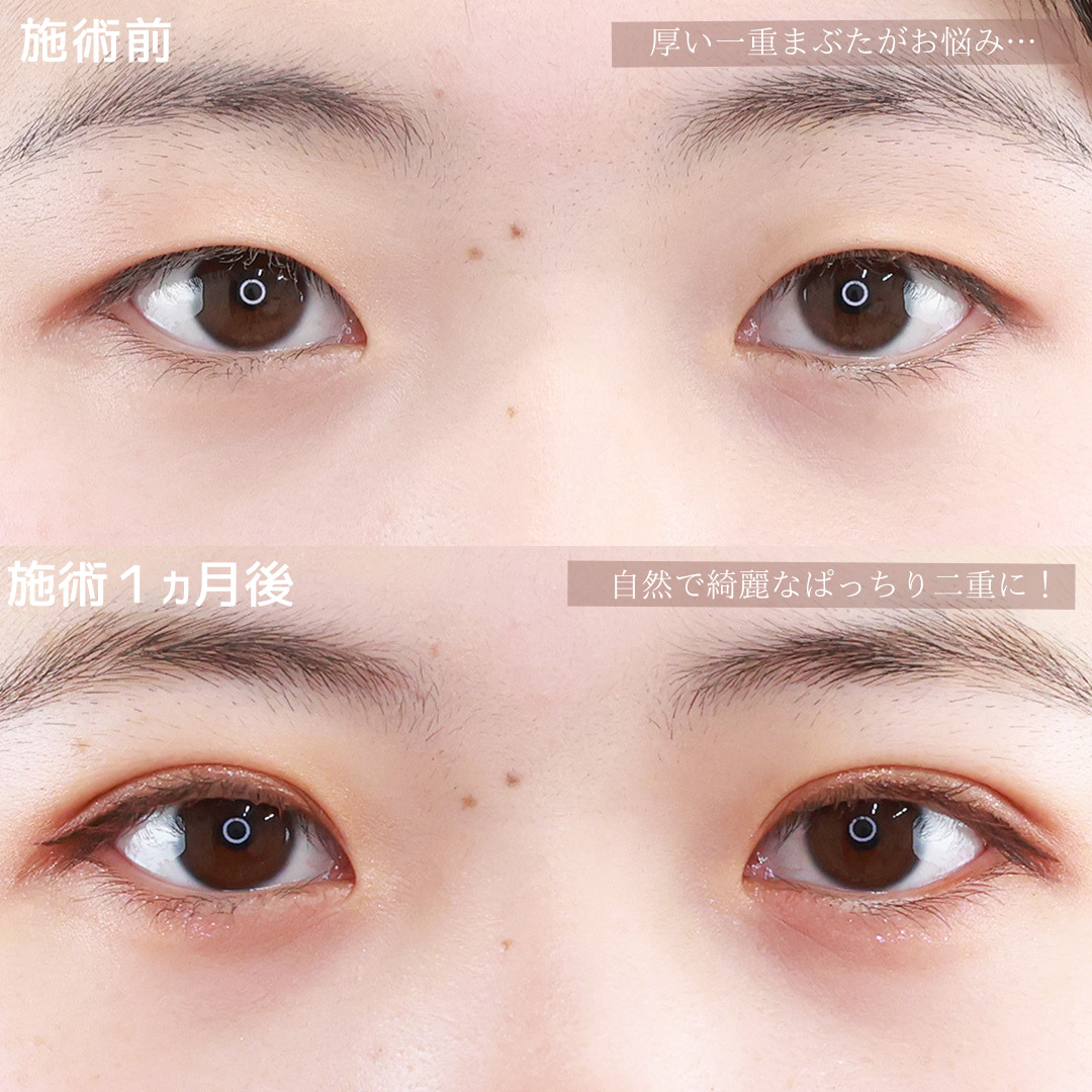 二重埋没法/目元：その他の症例写真 施術前後 