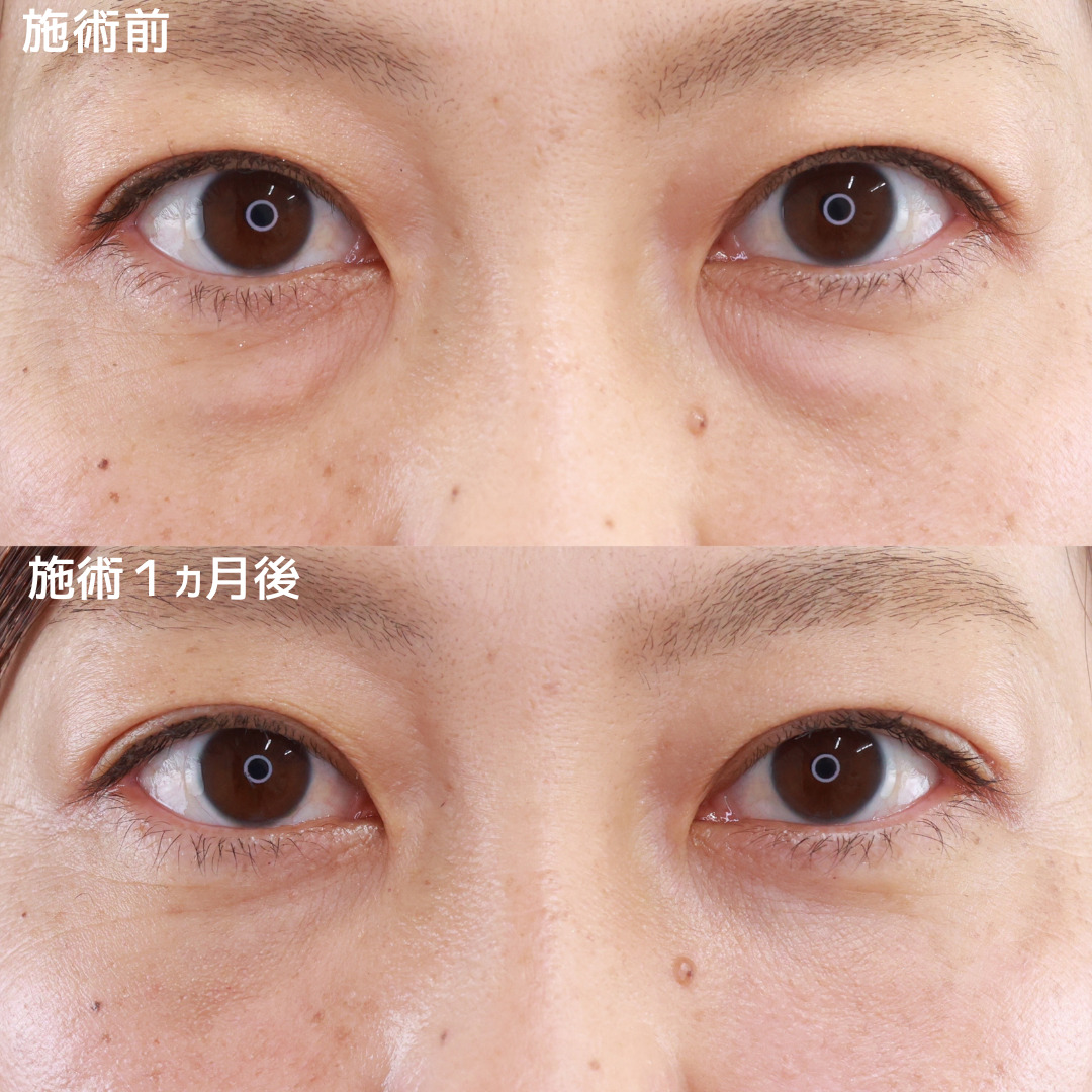 【クマ取り×脂肪注入】で老け顔の原因を改善し、若々しい印象へ！