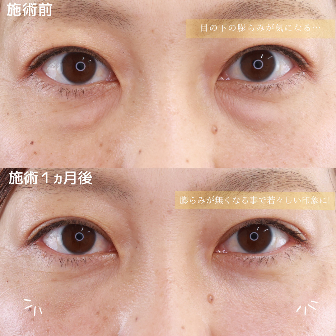 下眼瞼脱脂術（目の下のたるみ取り・目の下の脂肪ふくらみ取り）/顔の脂肪注入(コンデンスリッチフェイス)の症例写真 施術前後 