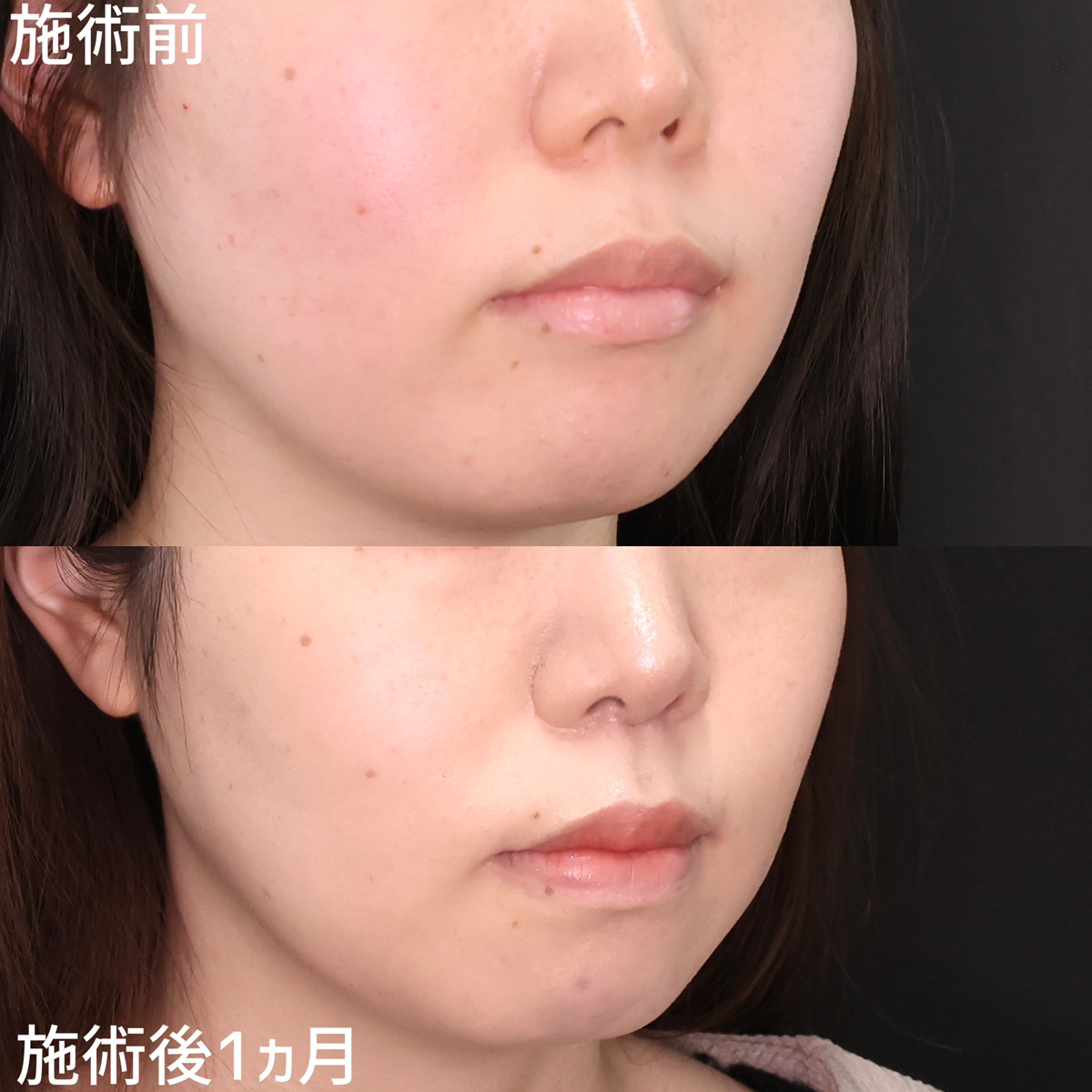 人中を短く、美人顔に！お鼻のバランスも整える