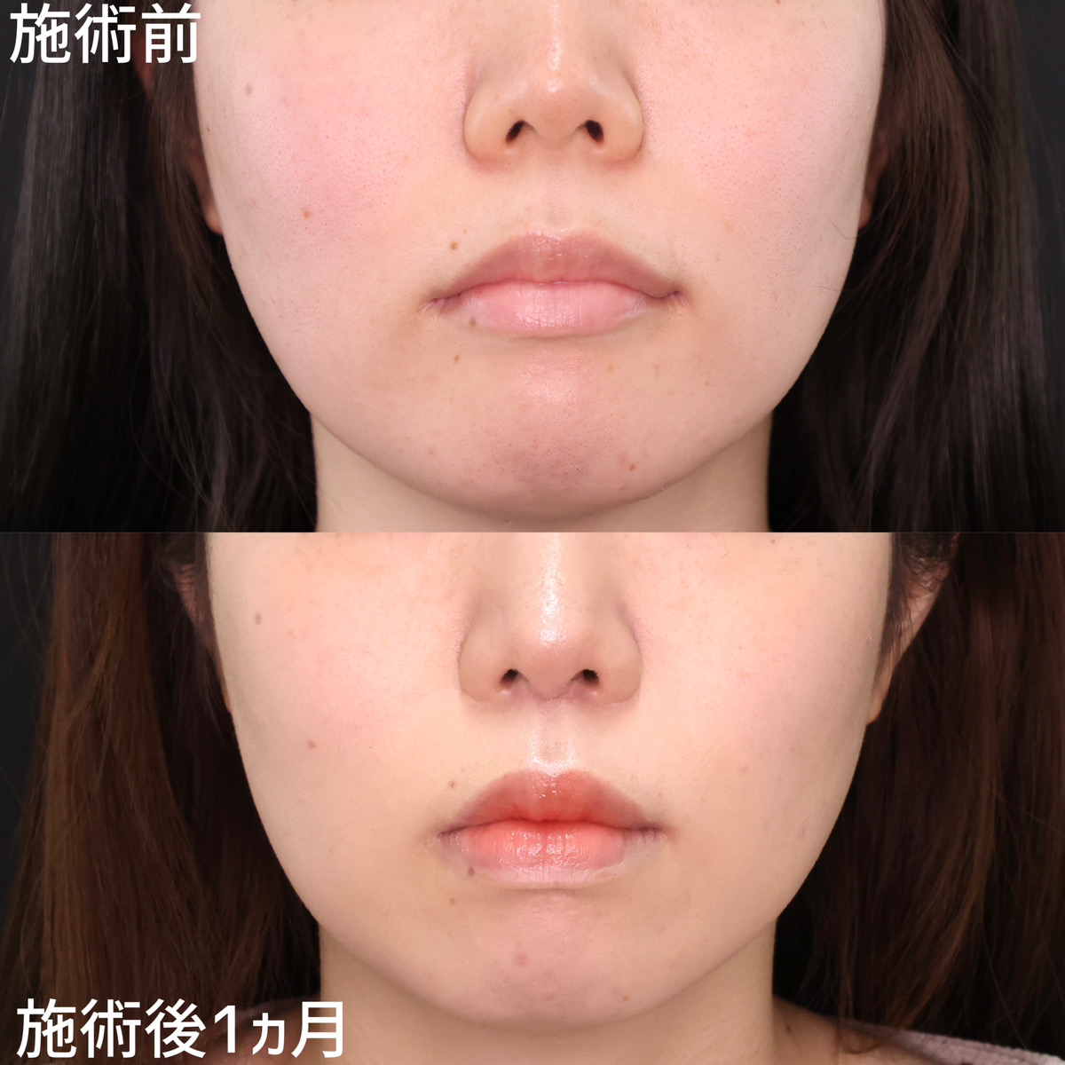 人中短縮術(リップリフト)・外側人中短縮術/ボトックス注射：その他の症例写真 施術前後 