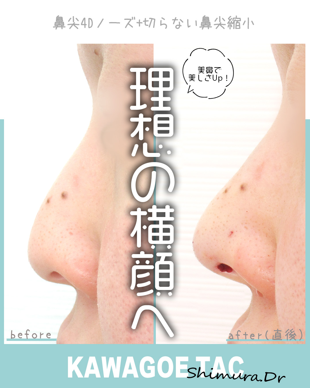 鼻尖形成・鼻尖縮小/鼻尖4Dノーズの症例写真 施術前後
