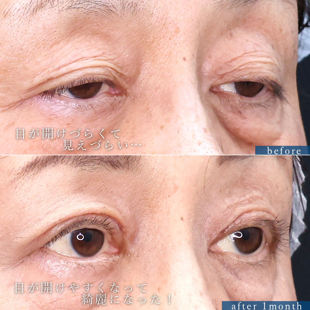 上眼瞼切開術/眼瞼下垂（目つき矯正）の症例写真 施術前後 