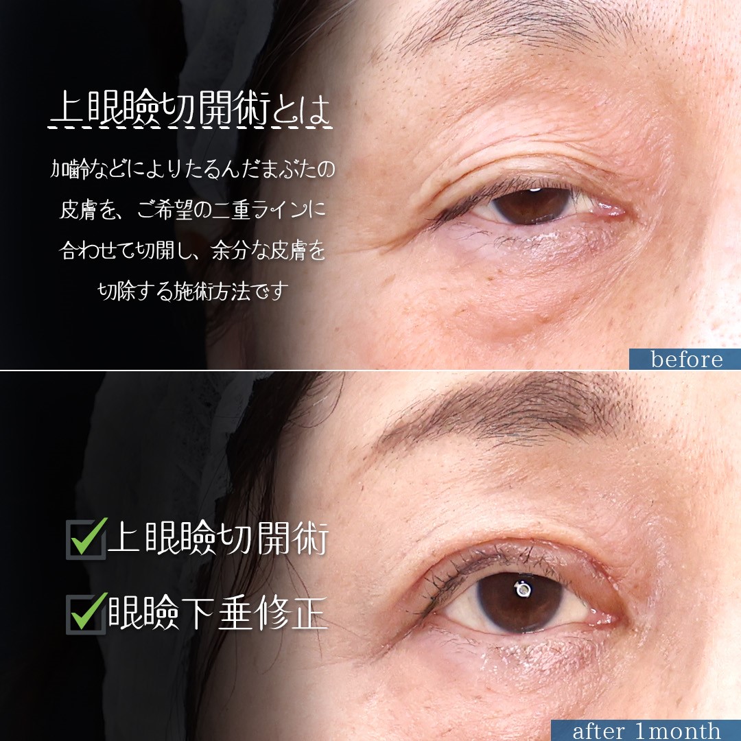 上眼瞼切開術/眼瞼下垂（目つき矯正）の症例写真 施術前後 