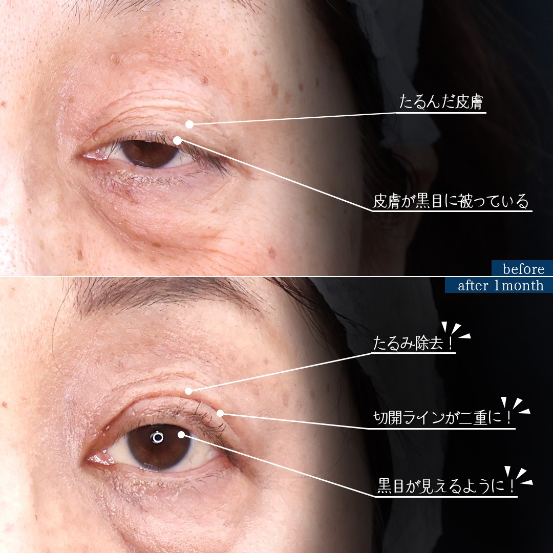上眼瞼切開術/眼瞼下垂（目つき矯正）の症例写真 施術前後 