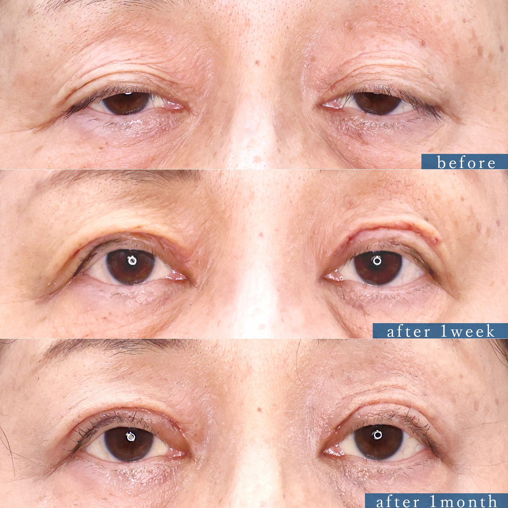 上眼瞼切開術/眼瞼下垂（目つき矯正）の症例写真 施術前後 