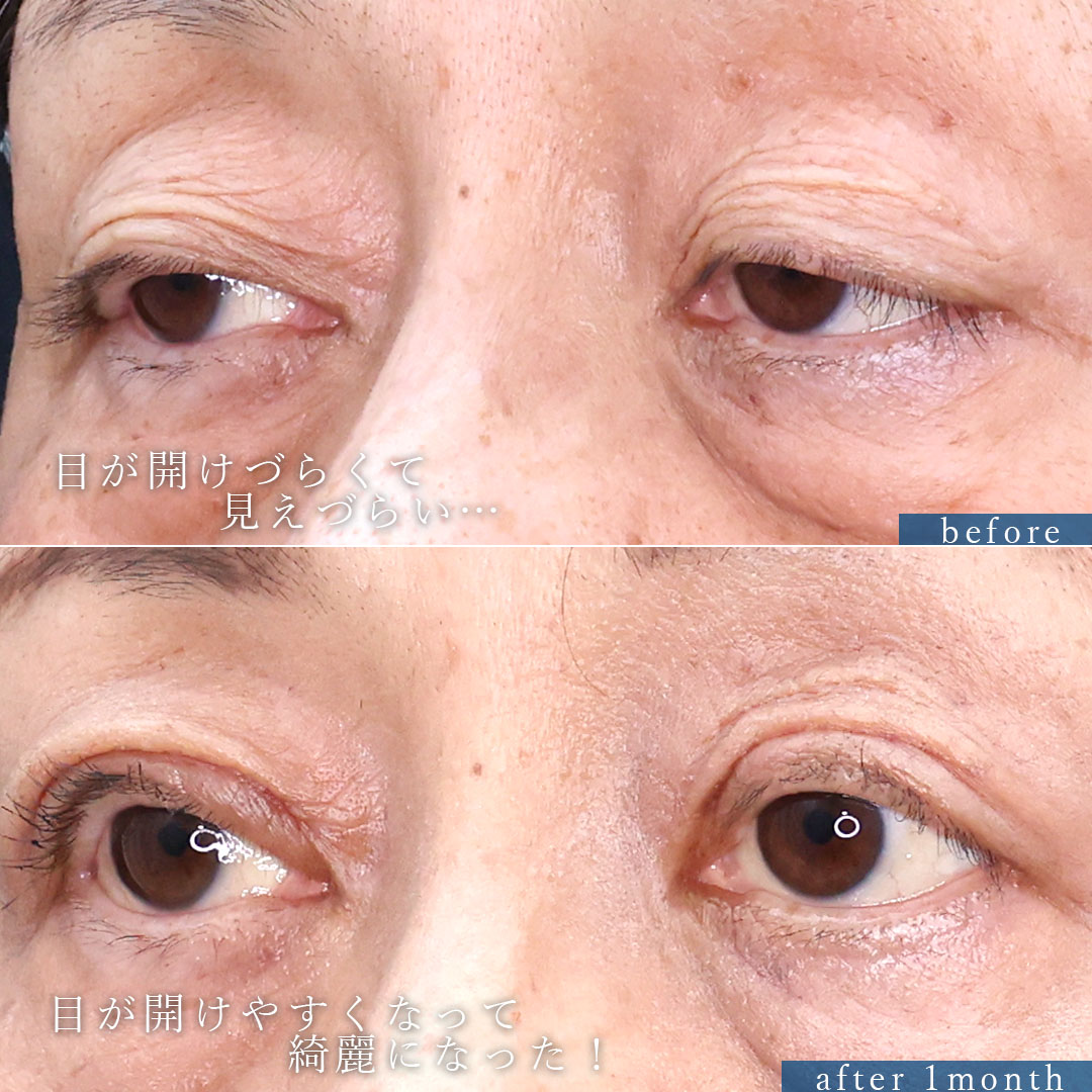 上眼瞼切開術/眼瞼下垂（目つき矯正）の症例写真 施術前後 