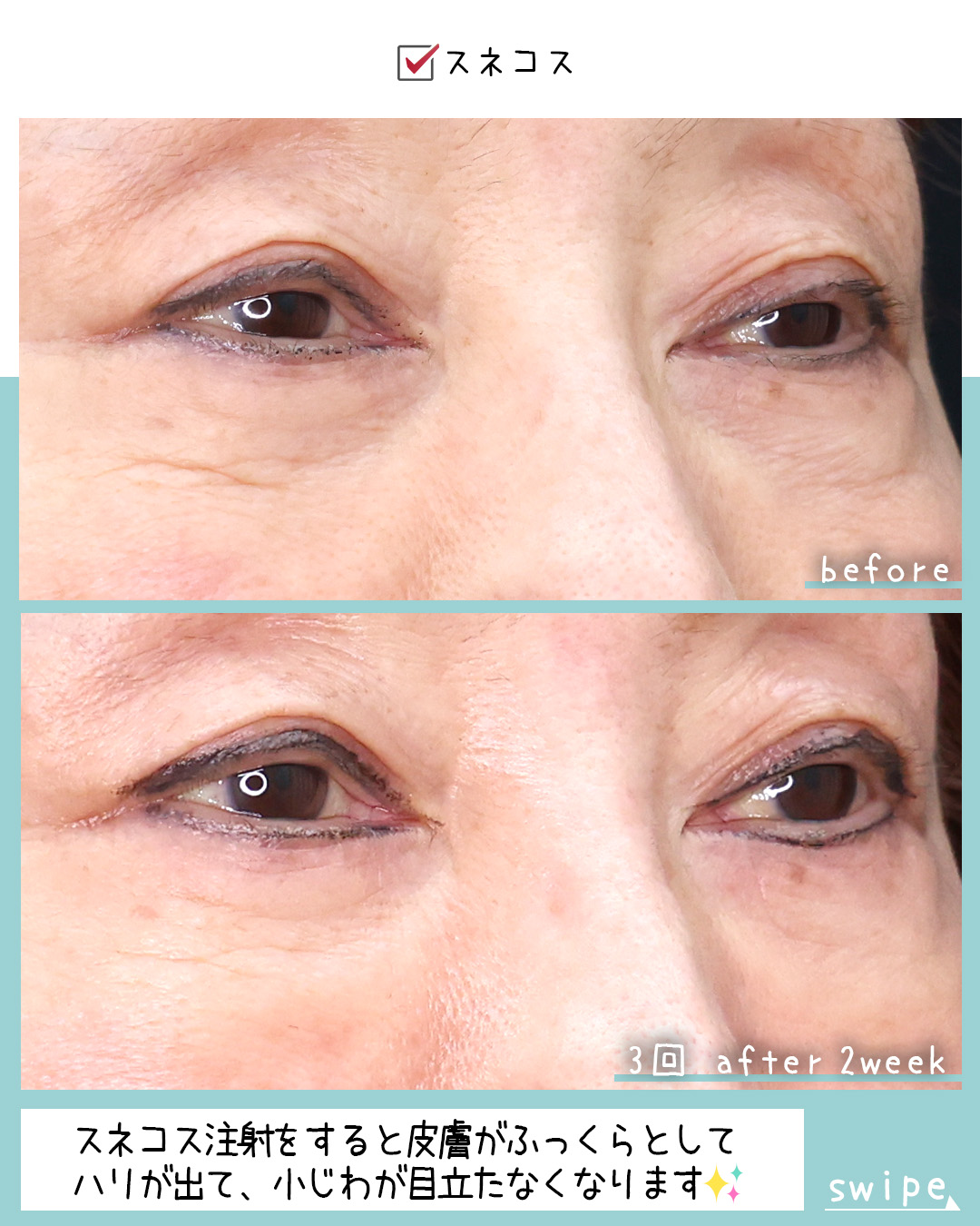 注射・プチ整形：その他/目の下のヒアルロン酸注射の症例写真 施術前後 