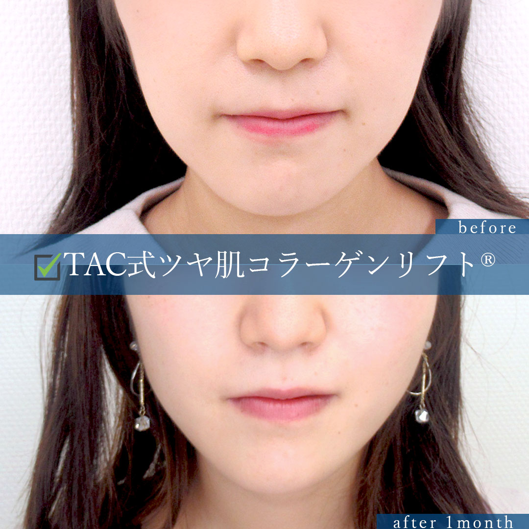 TAC式 ツヤ肌コラーゲンリフト®の症例写真 施術前後 