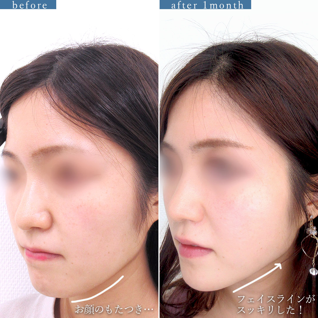 TAC式 ツヤ肌コラーゲンリフト®の症例写真 施術前後 