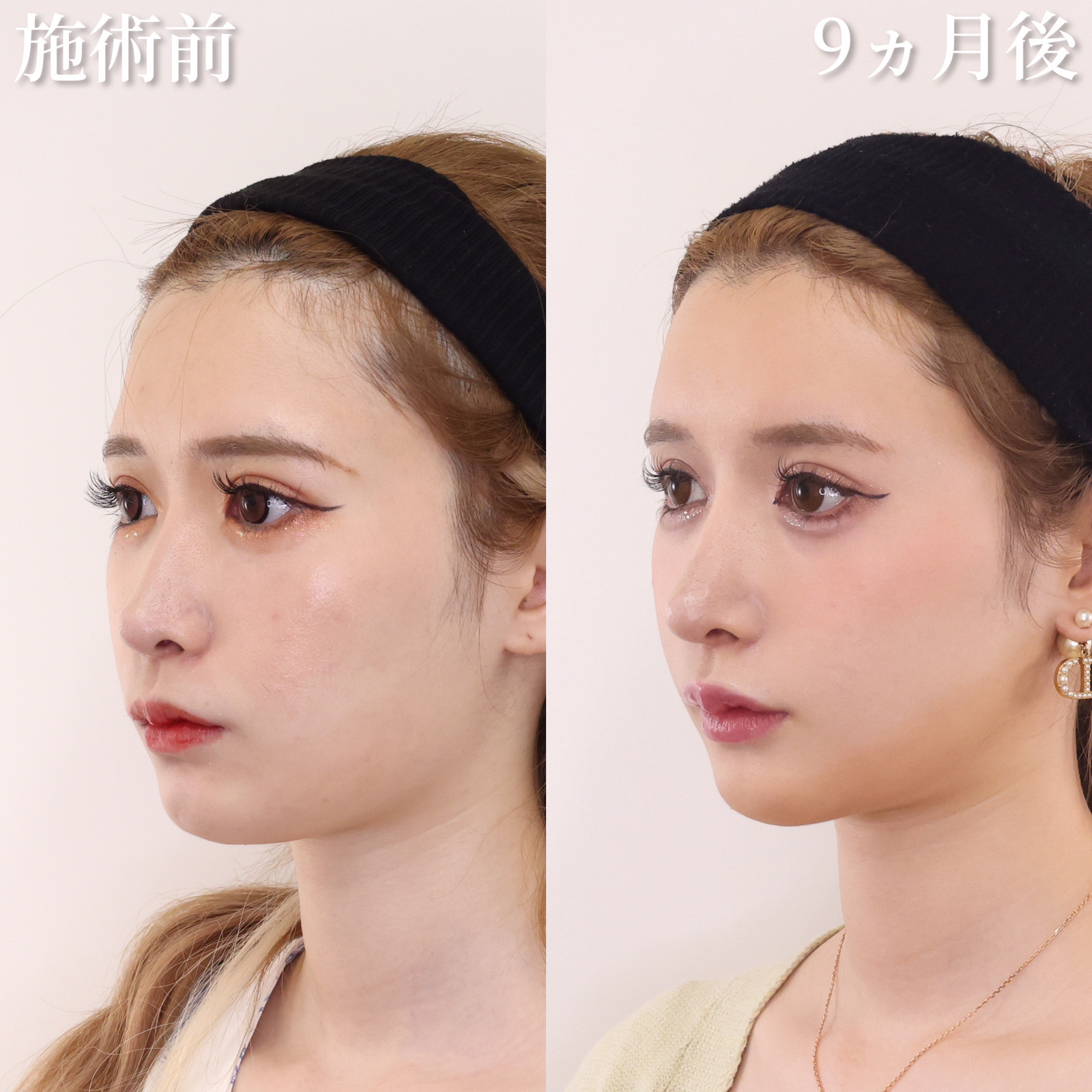 鼻中隔延長術/鼻先軟骨移植/隆鼻術(プロテーゼ・自家組織)の症例写真 施術前後