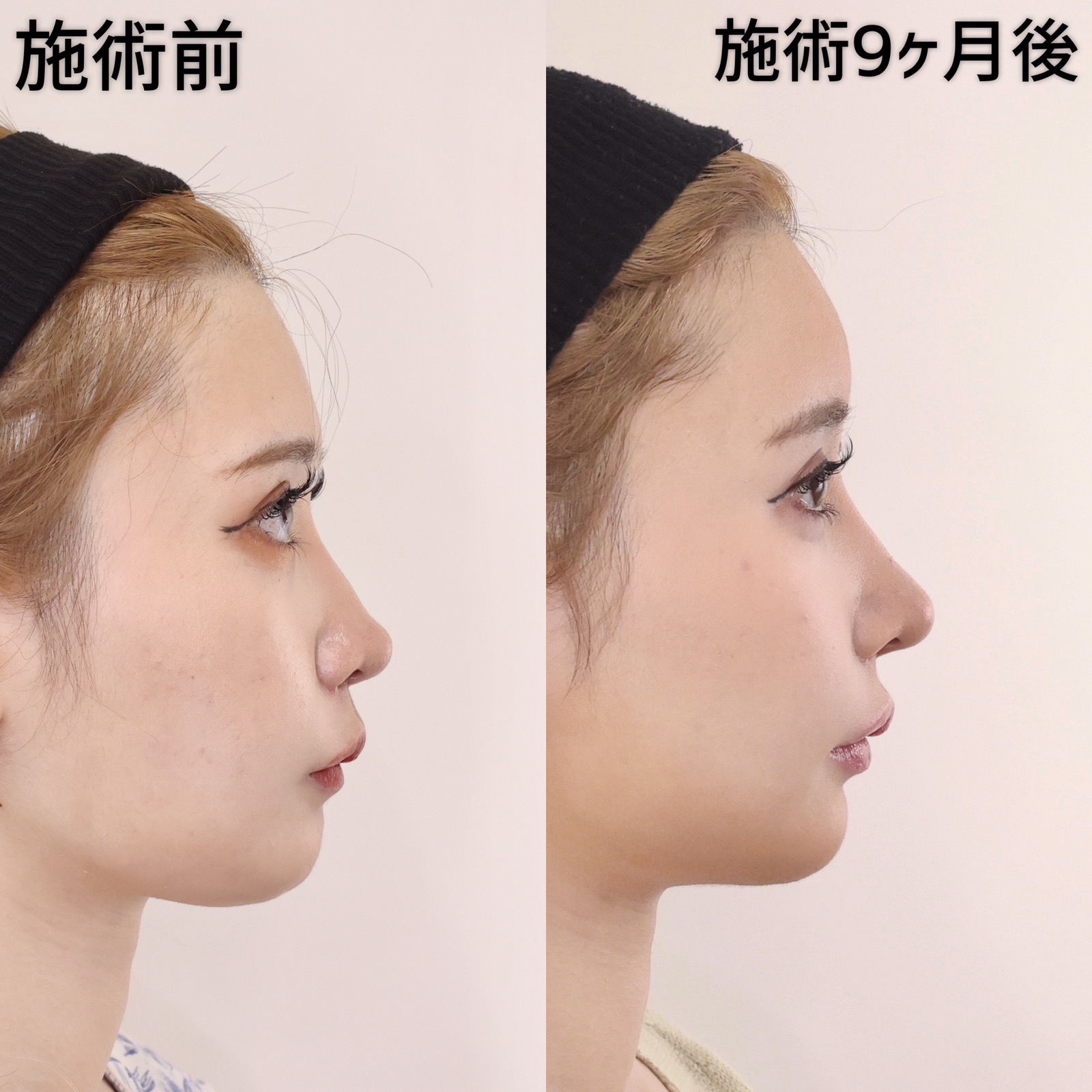 鼻中隔延長術/鼻先軟骨移植/隆鼻術(プロテーゼ・自家組織)の症例写真 施術前後