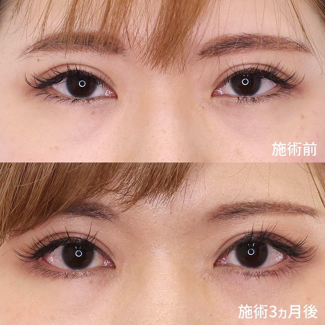 【グラマラスライン×目尻切開】で自然なタレ目に◎