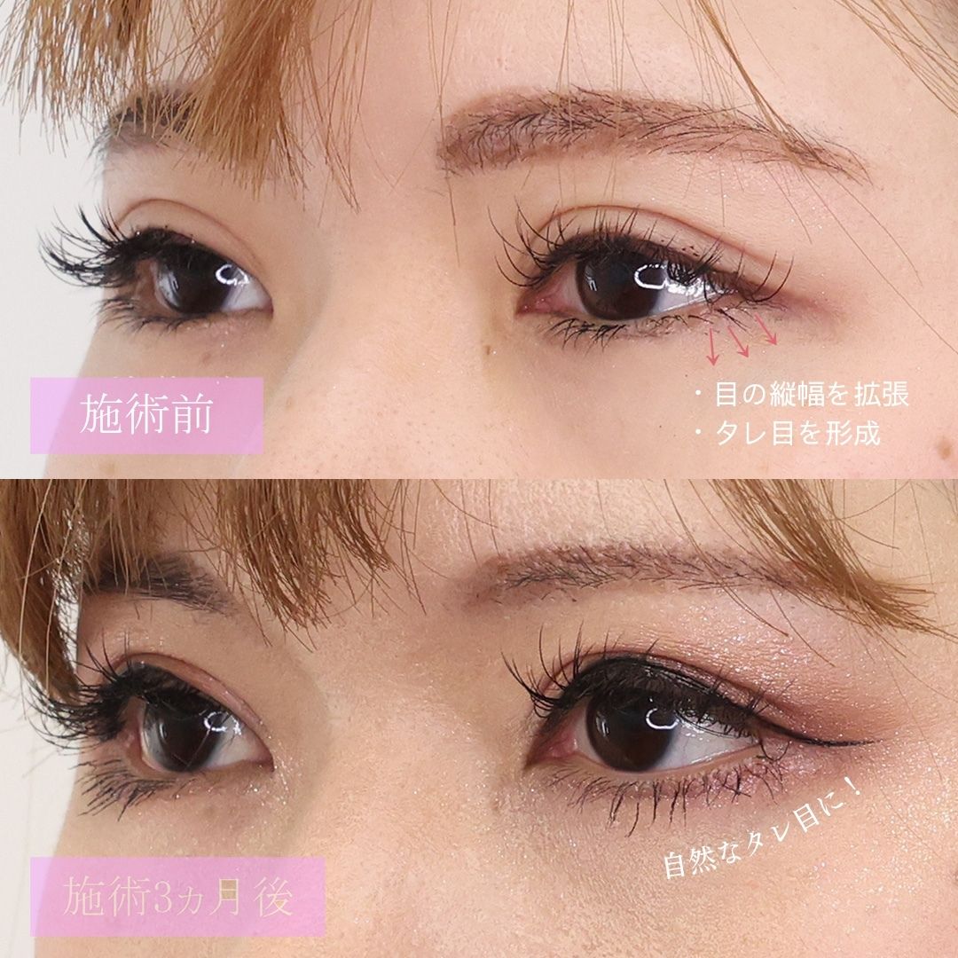グラマラスライン（タレ目形成）/目尻切開術の症例写真 施術前後 