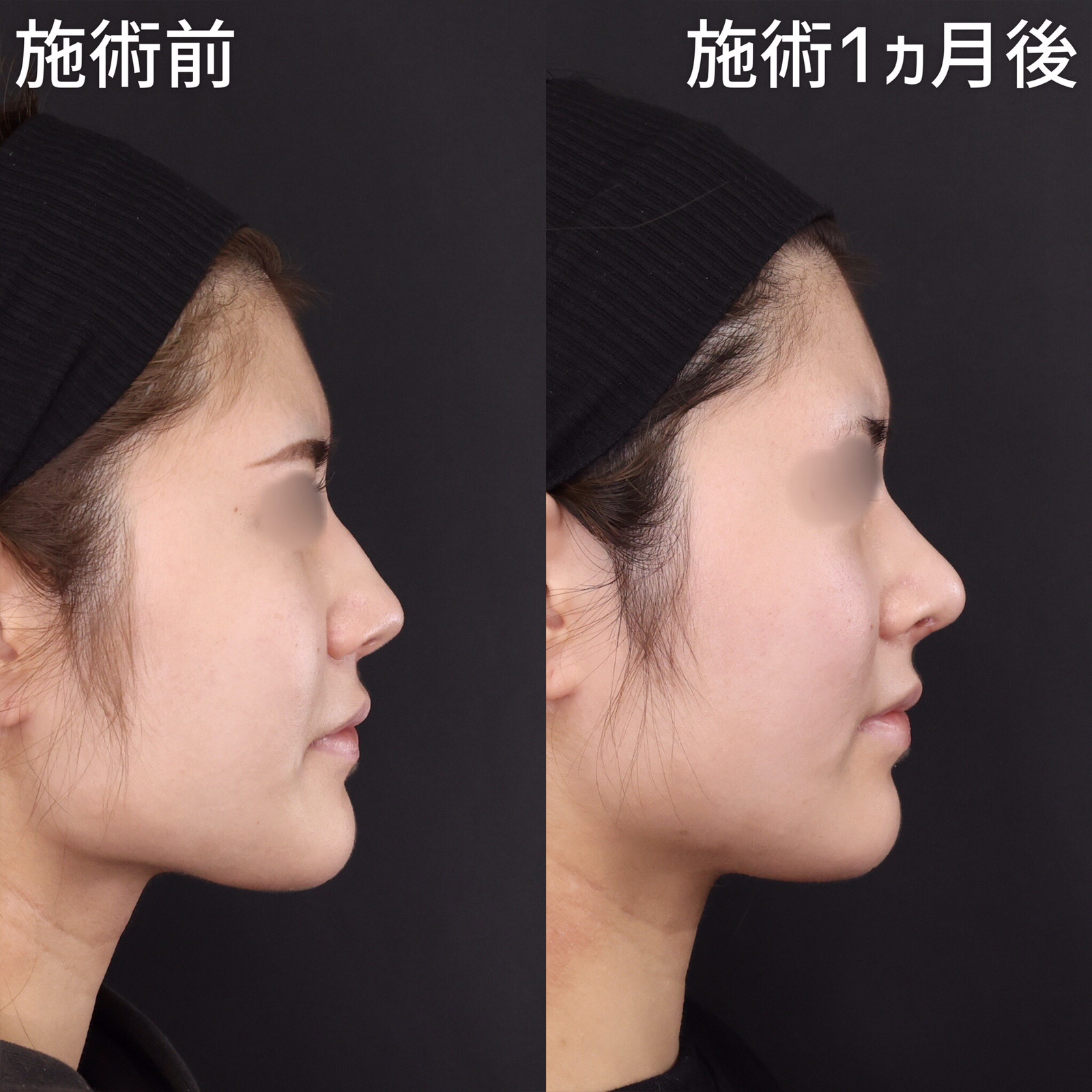 【ハンプ切除】ボコついた鼻筋を滑らかに整える