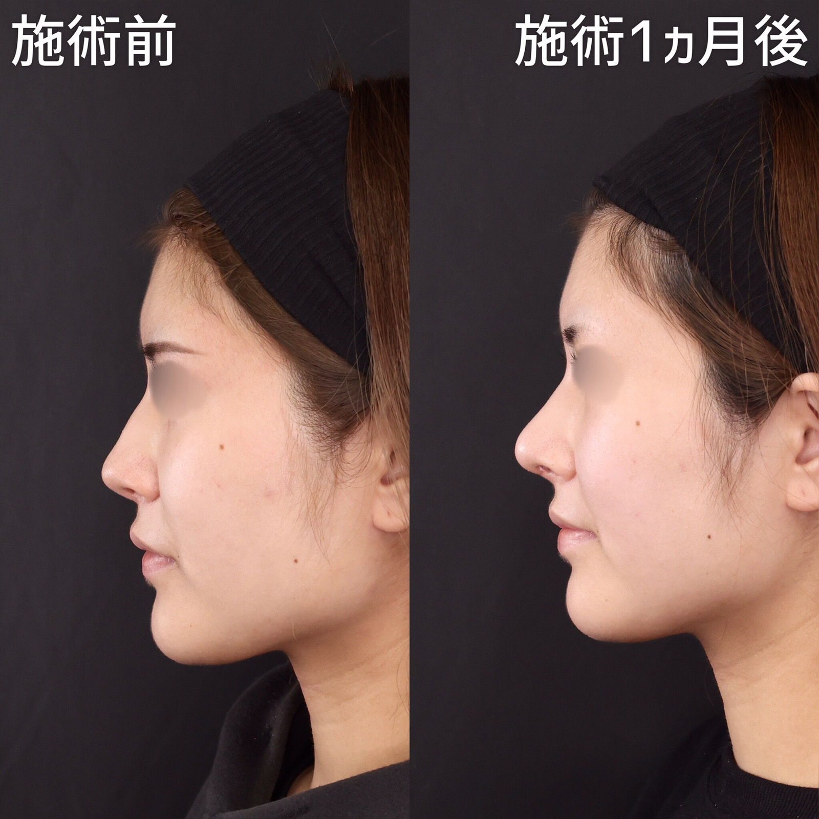 鼻尖形成・鼻尖縮小/鼻先軟骨移植の症例写真 施術前後 