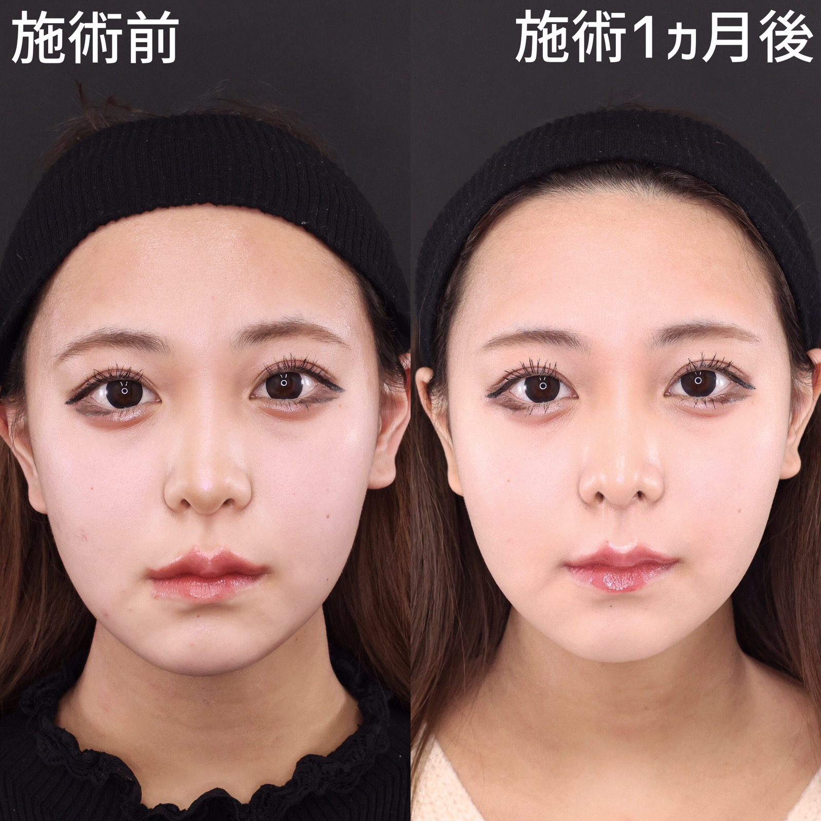 鼻尖形成・鼻尖縮小/鼻先軟骨移植/Cカール・猫手術の症例写真 施術前後 