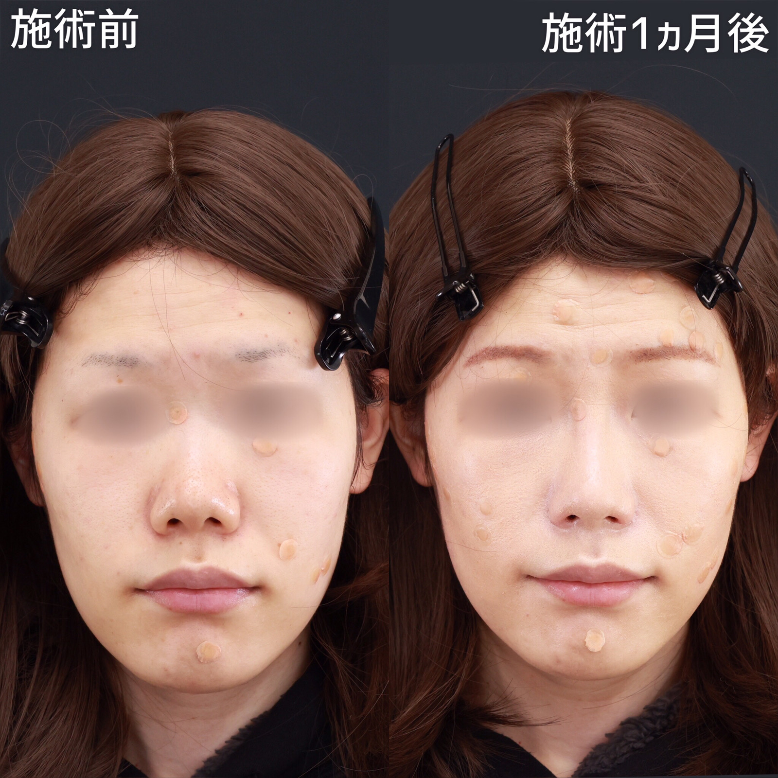 【鼻孔縁挙上&amp;小鼻縮小】正面から見た鼻の印象を変える