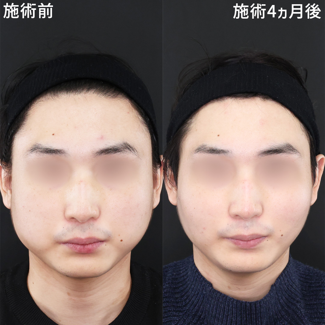 【小顔施術】頬の丸いコブのような輪郭を解消!!!