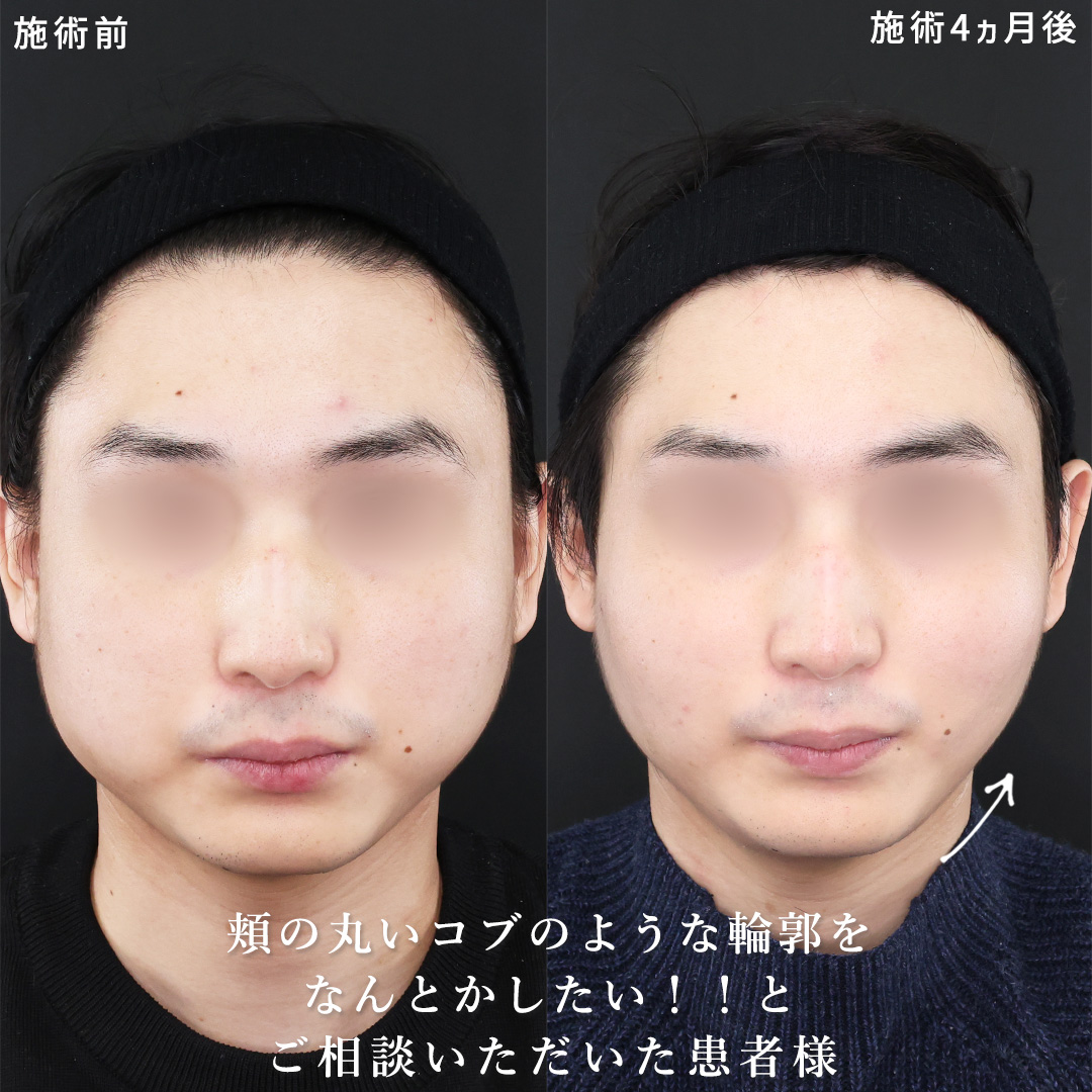 TAC式 ツヤ肌コラーゲンリフト®/バッカルファット除去/顔の脂肪吸引の症例写真 施術前後 