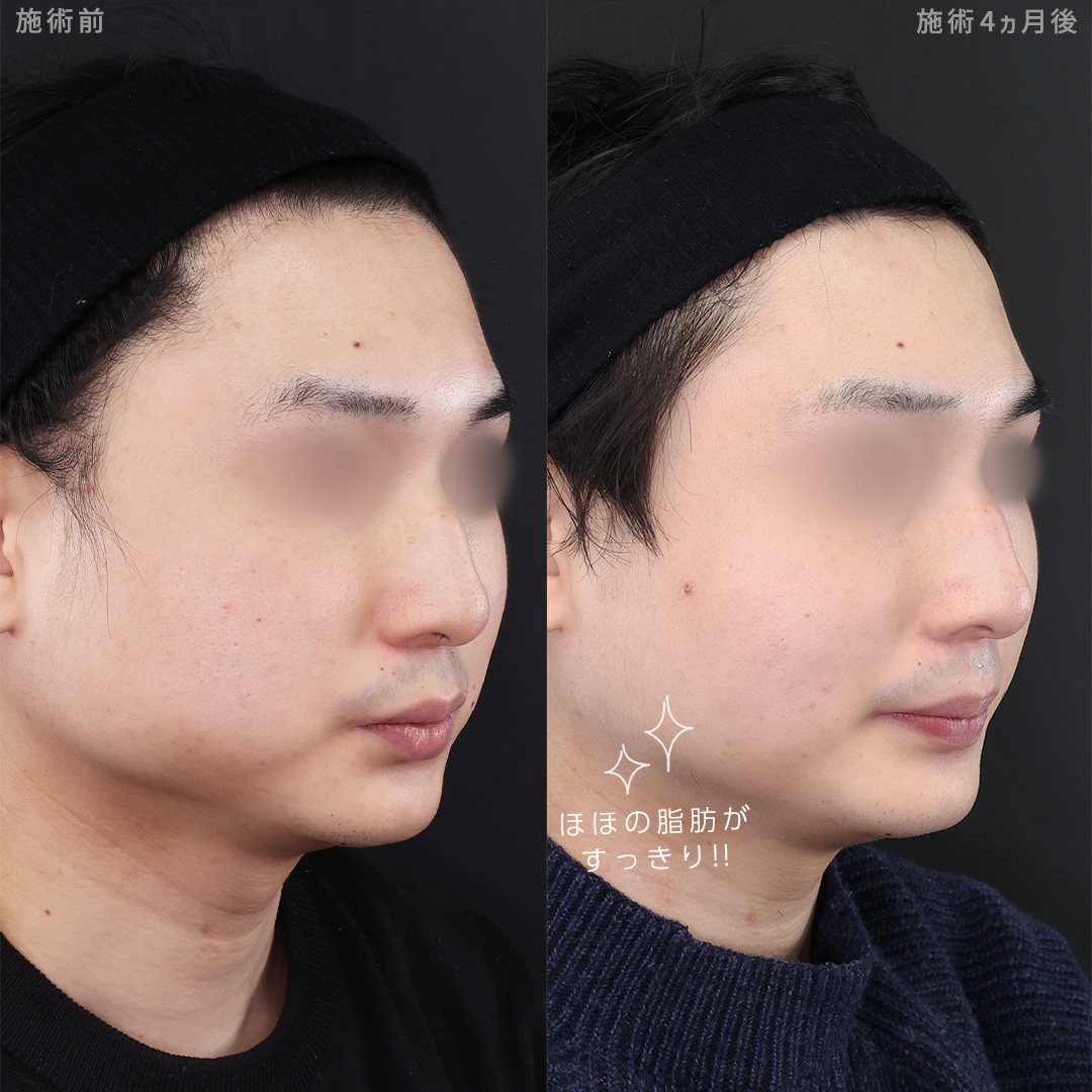 TAC式 ツヤ肌コラーゲンリフト®/バッカルファット除去/顔の脂肪吸引の症例写真 施術前後 