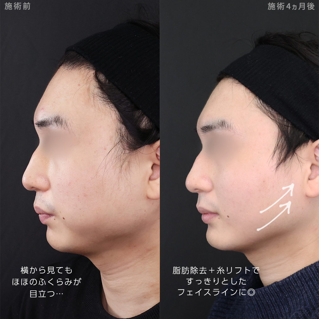 TAC式 ツヤ肌コラーゲンリフト®/バッカルファット除去/顔の脂肪吸引の症例写真 施術前後 