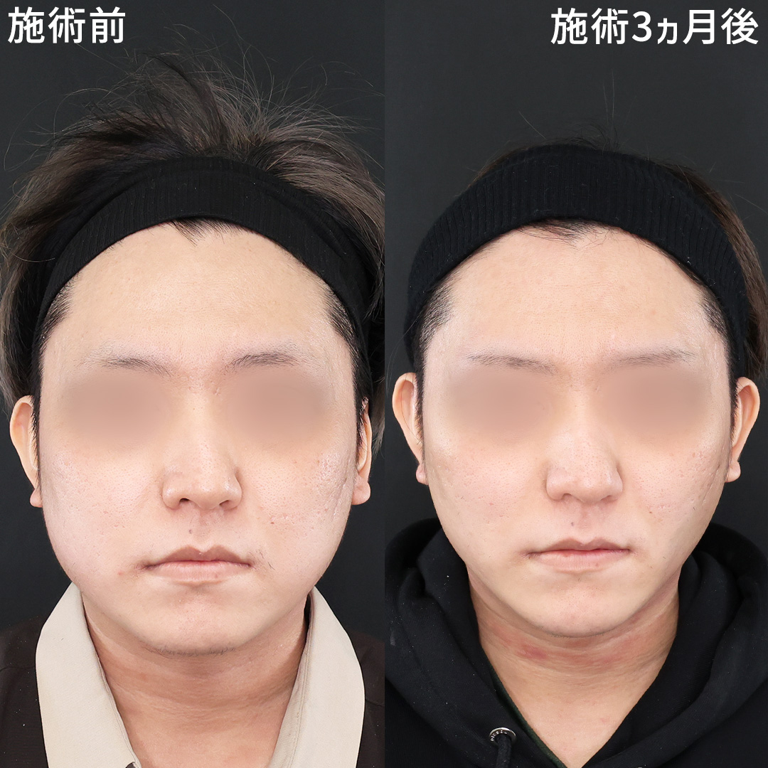 メンズ美容《脂肪除去×糸リフト》ですっきりフェイスラインに◎