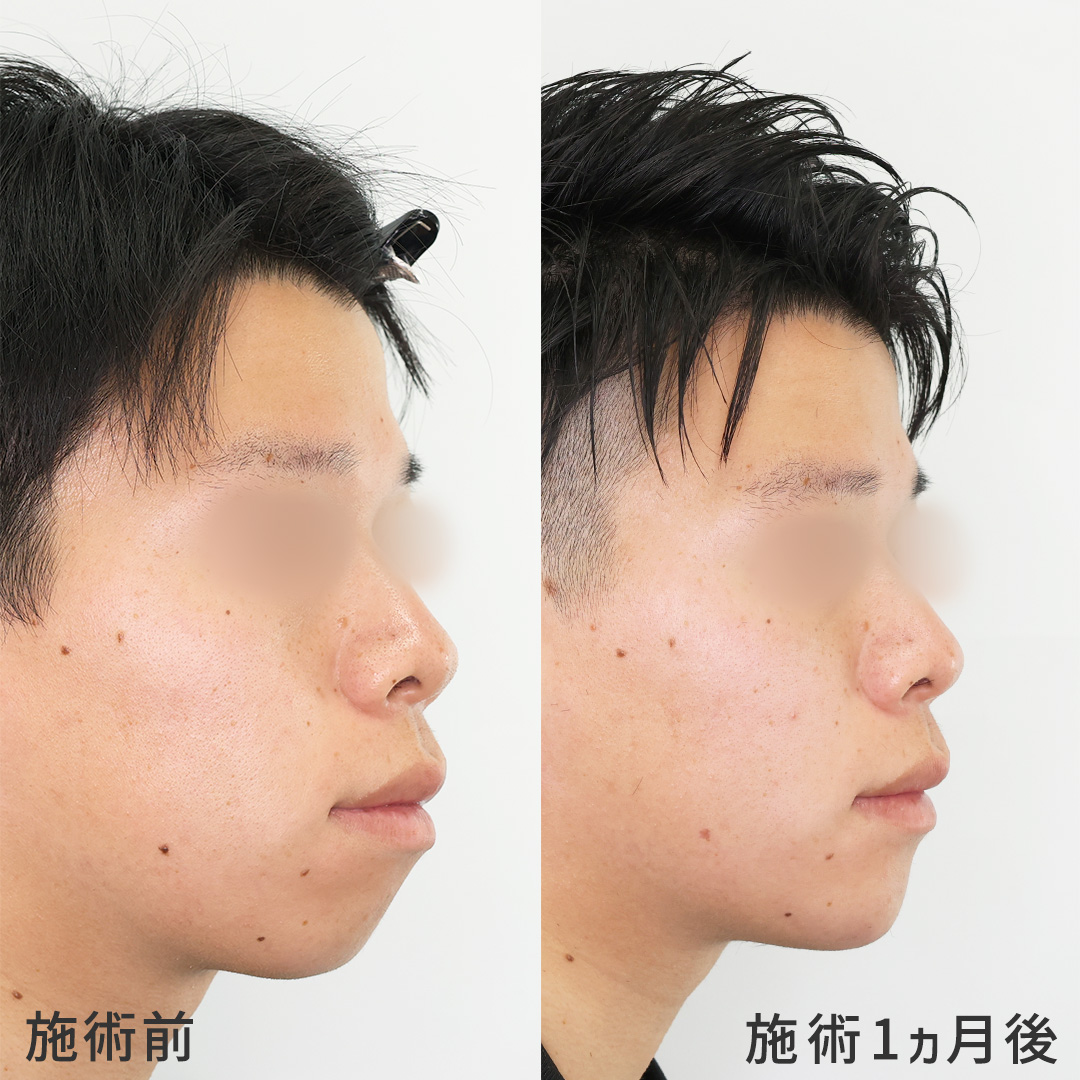 顎先を整えて《一気に垢抜け》