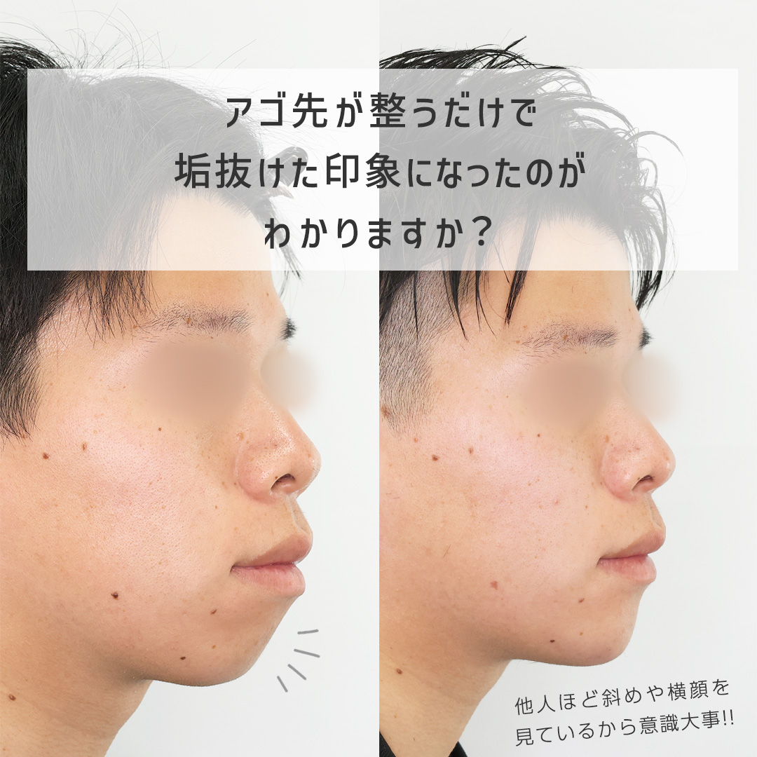 顎のヒアルロン酸注射の症例写真 施術前後 