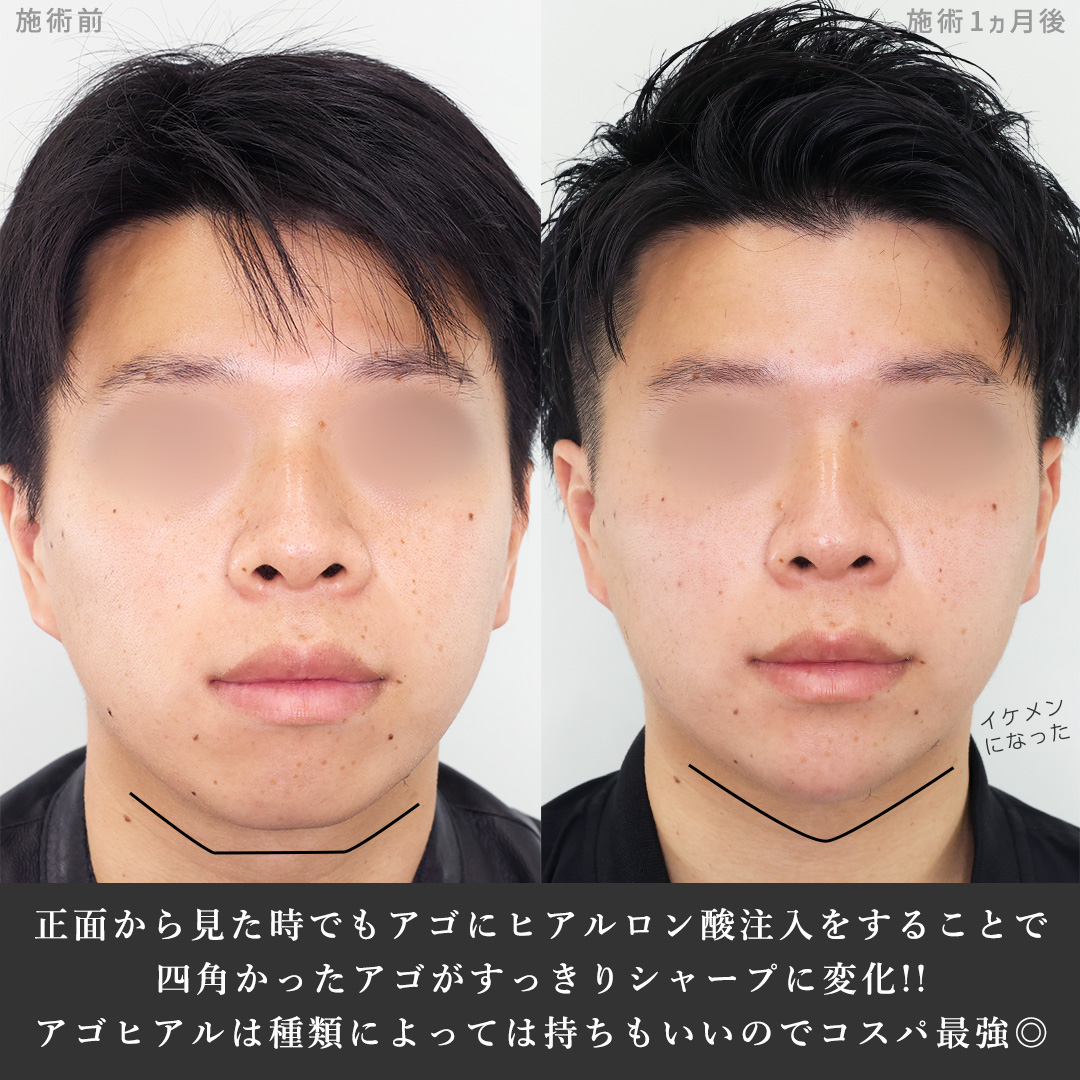 顎のヒアルロン酸注射の症例写真 施術前後 