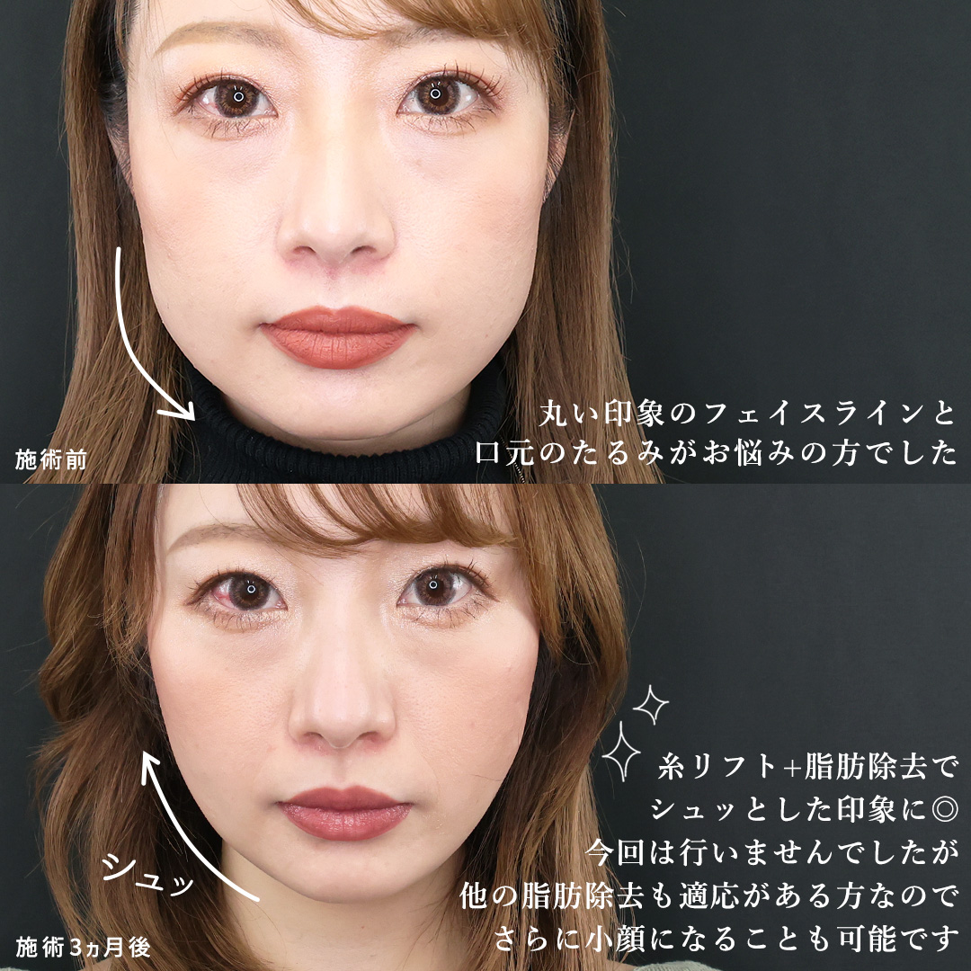 小顔整形｜パーフェクトフェイスライン/TAC式 ツヤ肌コラーゲンリフト®/ジョールファット除去の症例写真 施術前後 