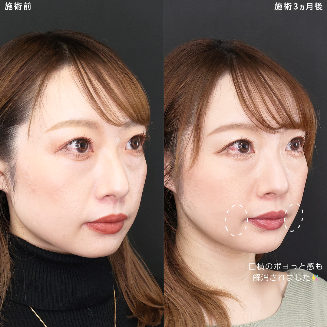 小顔整形｜パーフェクトフェイスライン/TAC式 ツヤ肌コラーゲンリフト®/ジョールファット除去の症例写真 施術前後 