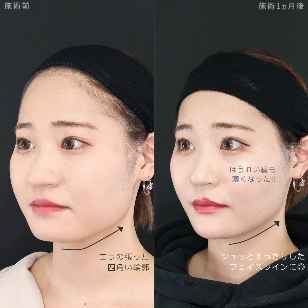 TAC式 ツヤ肌コラーゲンリフト®/メーラーファット除去/顎のヒアルロン酸注射の症例写真 施術前後 