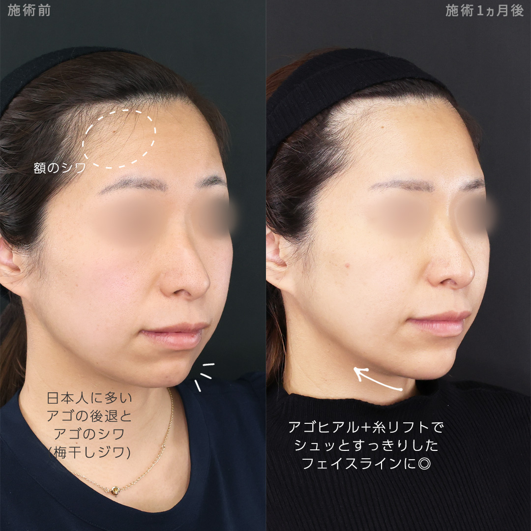 TAC式 ツヤ肌コラーゲンリフト®/TAC式 ショッピングリフト/顎のヒアルロン酸注射の症例写真 施術前後 