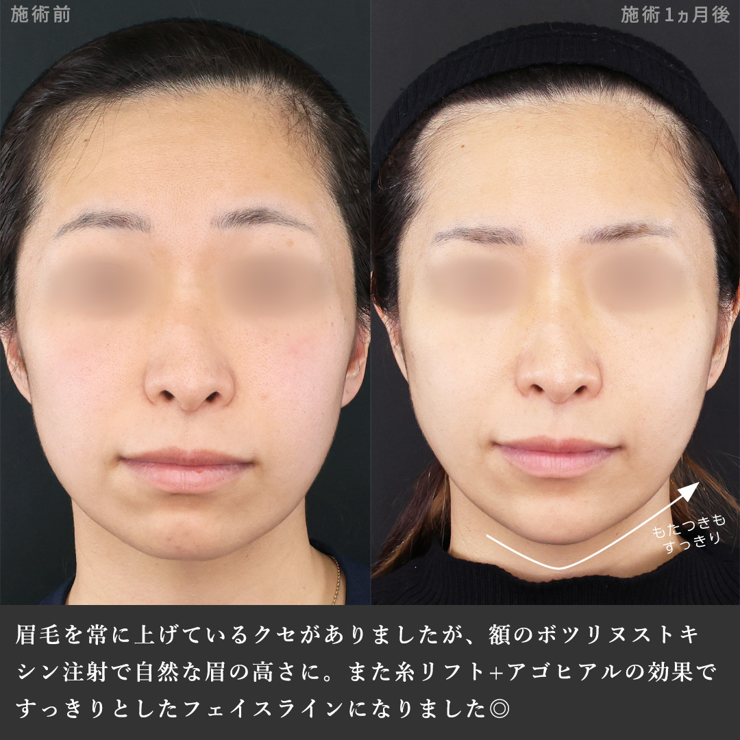 TAC式 ツヤ肌コラーゲンリフト®/TAC式 ショッピングリフト/顎のヒアルロン酸注射の症例写真 施術前後 