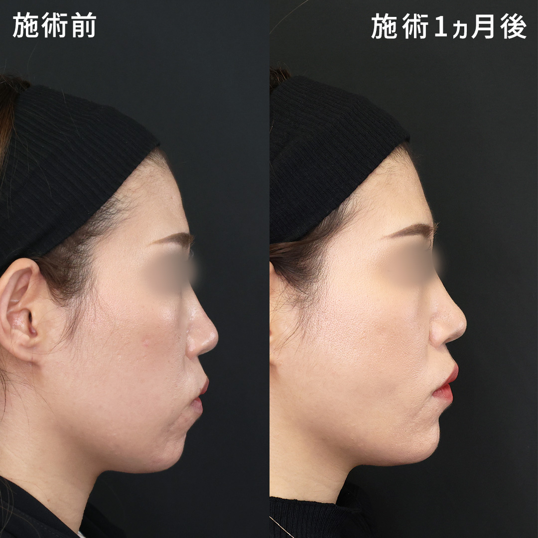 小顔整形|パーフェクトフェイスライン/TAC式 ツヤ肌コラーゲンリフト®/ジョールファット除去の症例写真 施術前後