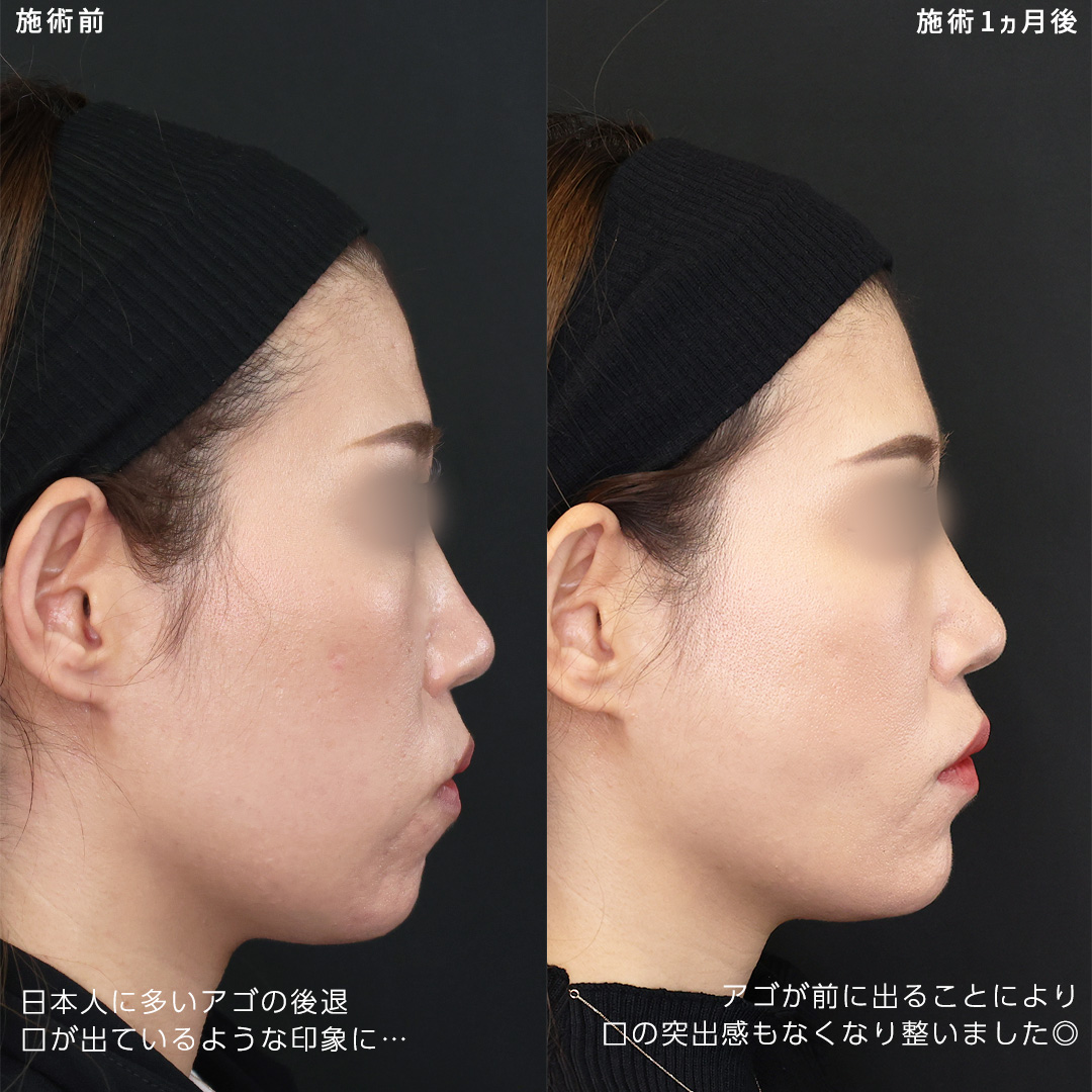 小顔整形|パーフェクトフェイスライン/TAC式 ツヤ肌コラーゲンリフト®/ジョールファット除去の症例写真 施術前後