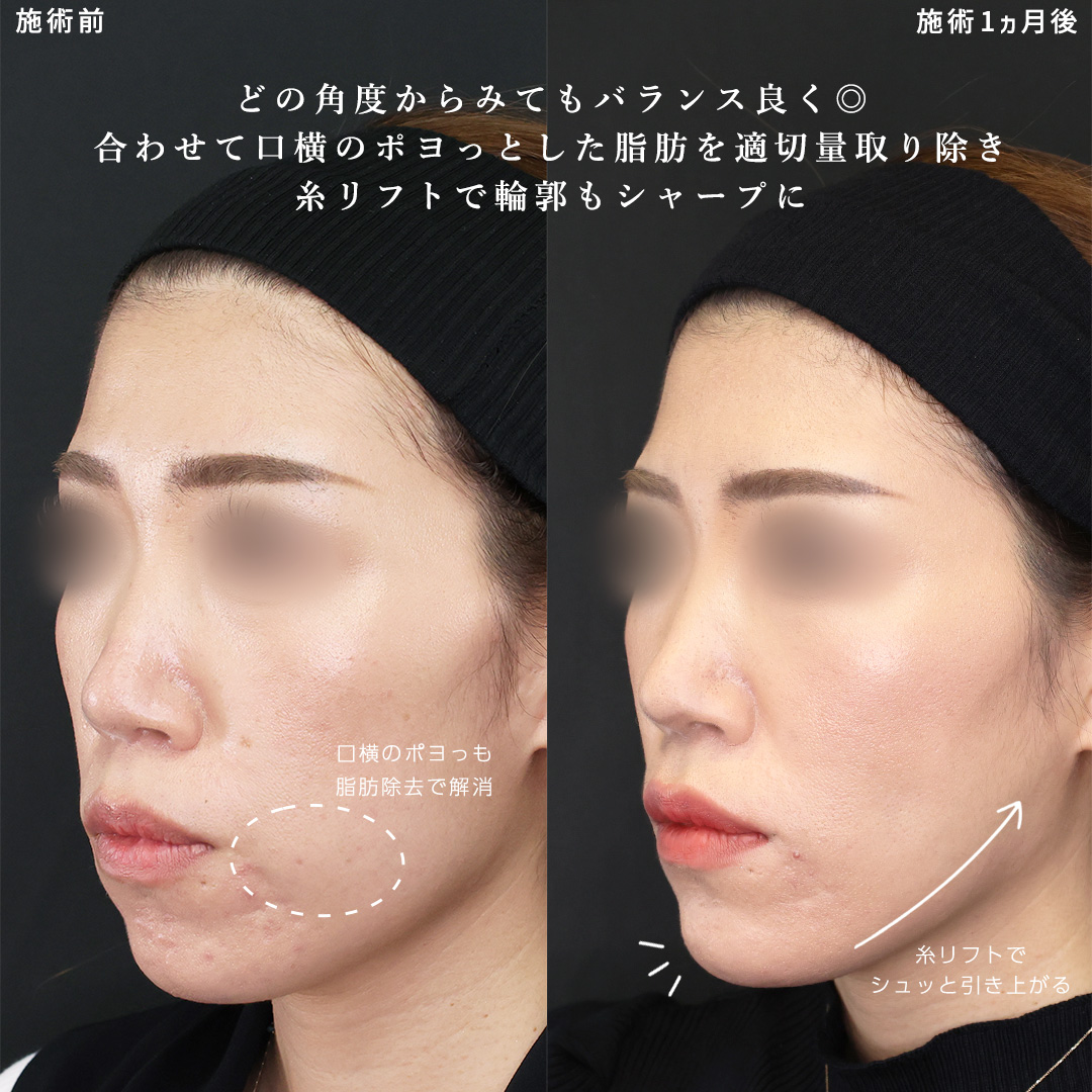 小顔整形|パーフェクトフェイスライン/TAC式 ツヤ肌コラーゲンリフト®/ジョールファット除去の症例写真 施術前後
