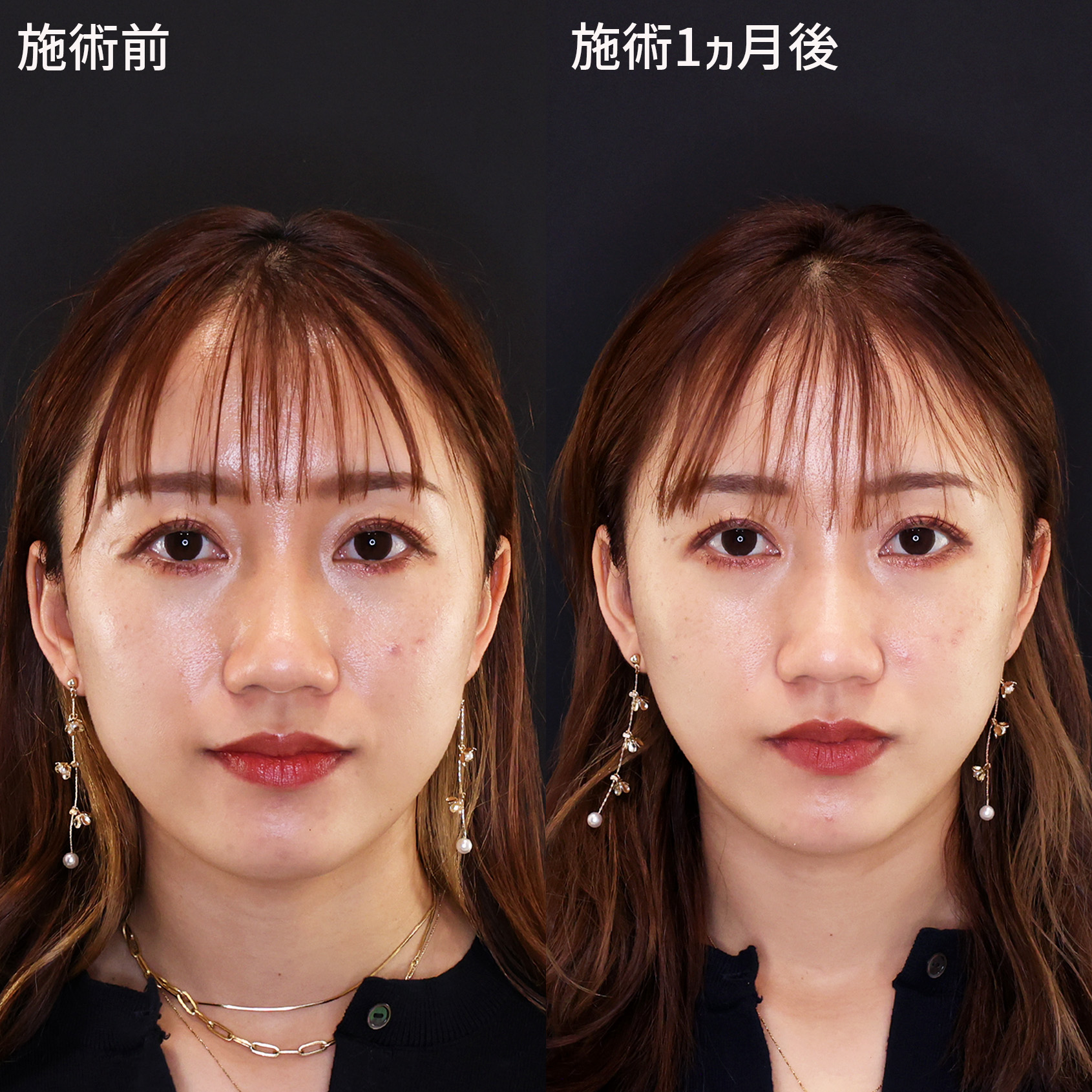 ナチュラル小顔へアップデート【糸リフト×エラボト】