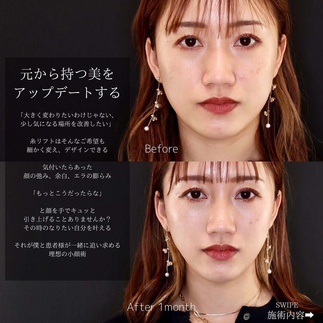 TAC式 ツヤ肌コラーゲンリフト®/エラボトックス注射の症例写真 施術前後 