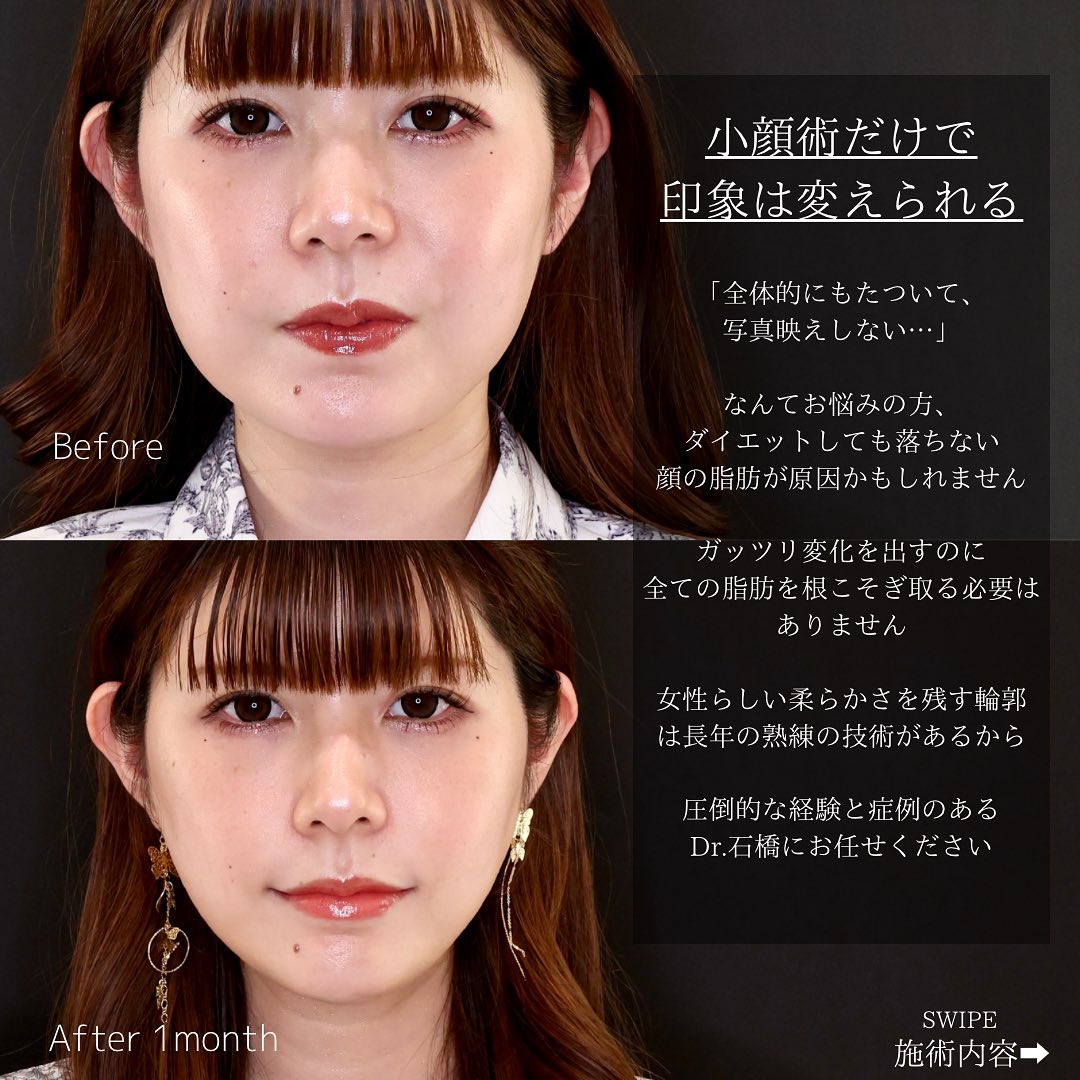 TAC式 ツヤ肌コラーゲンリフト®/エラボトックス注射の症例写真 施術前後 