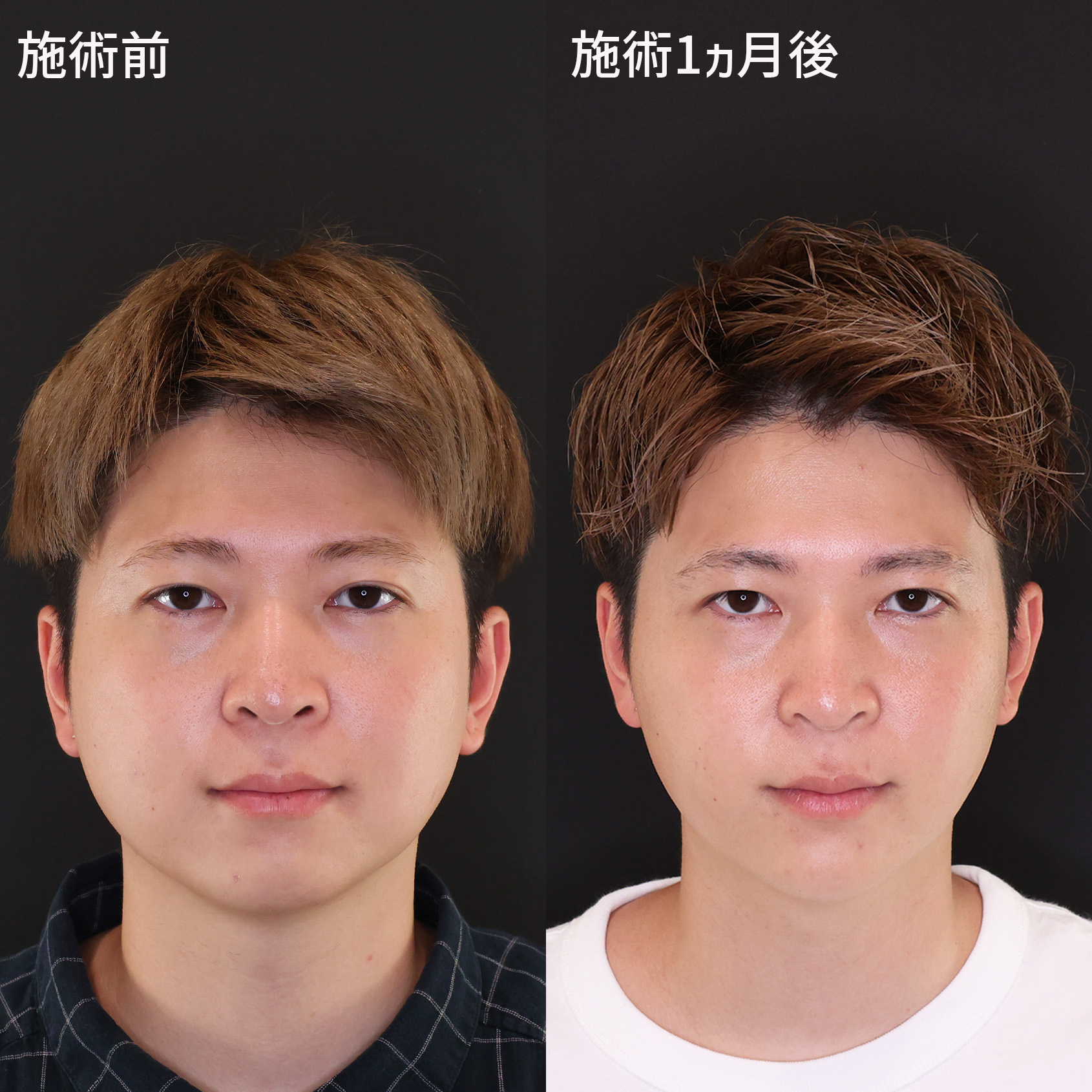 もたつき解消♪すっきり小顔イケメン！【パーフェクトフェイスライン】